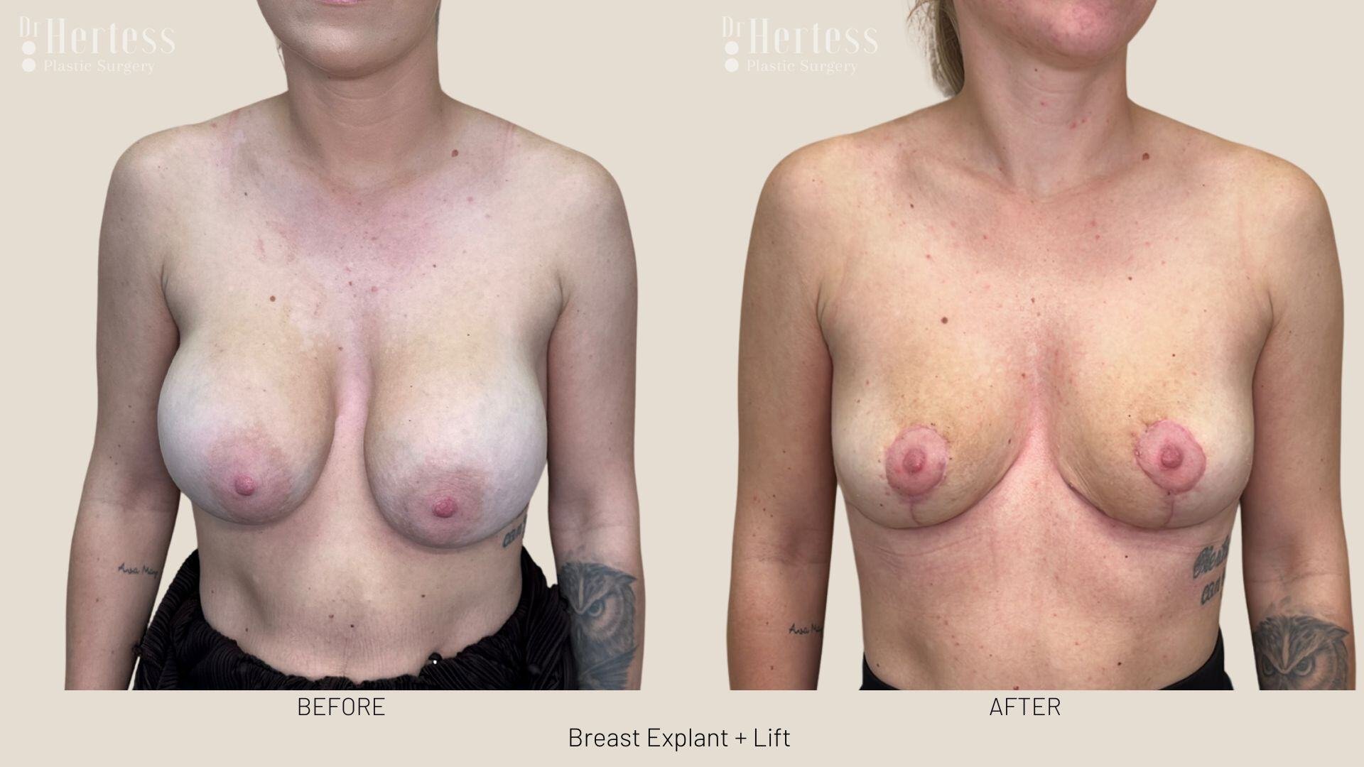 breast explant and lift photos