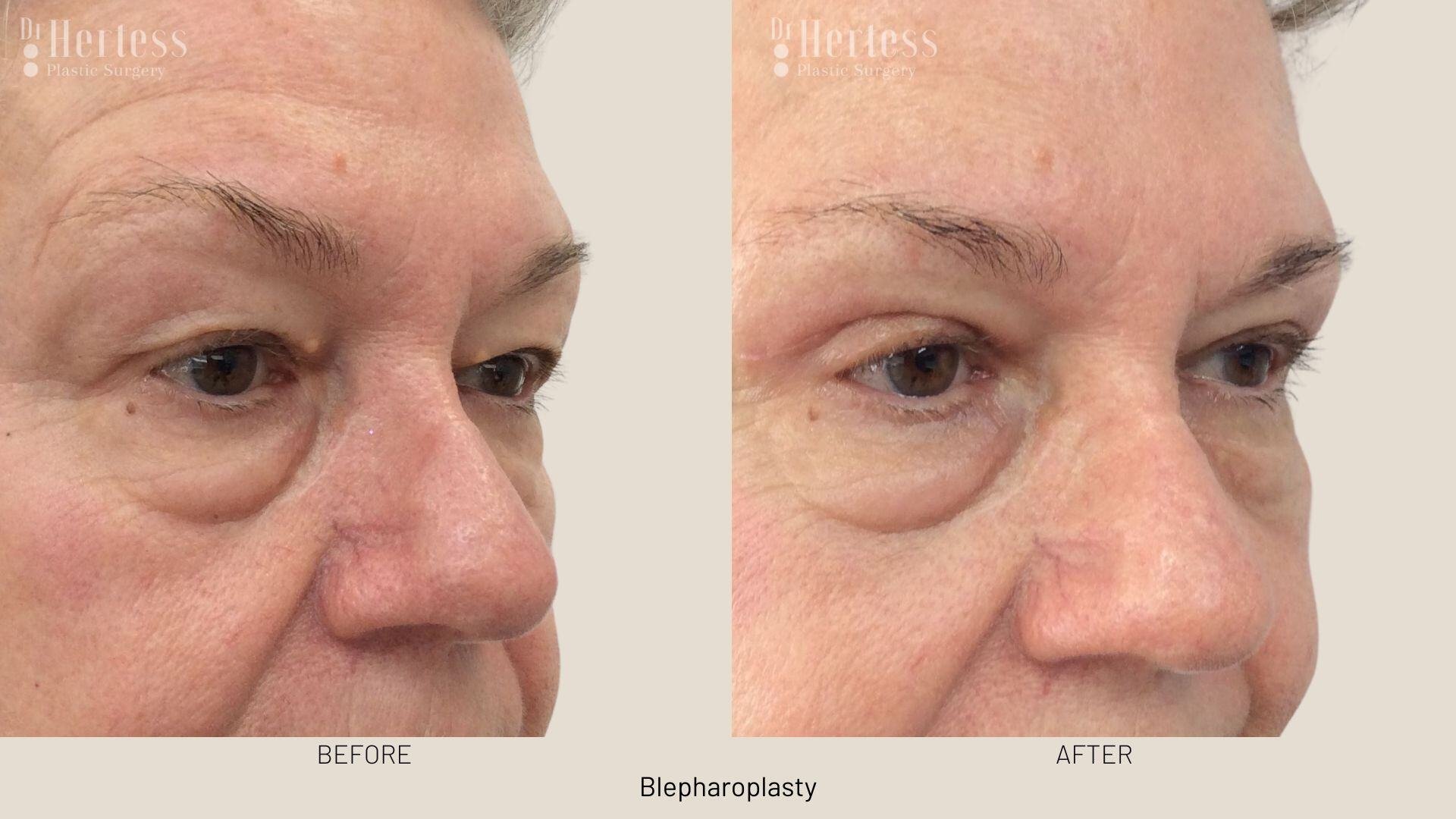 eyelid surgery before and after