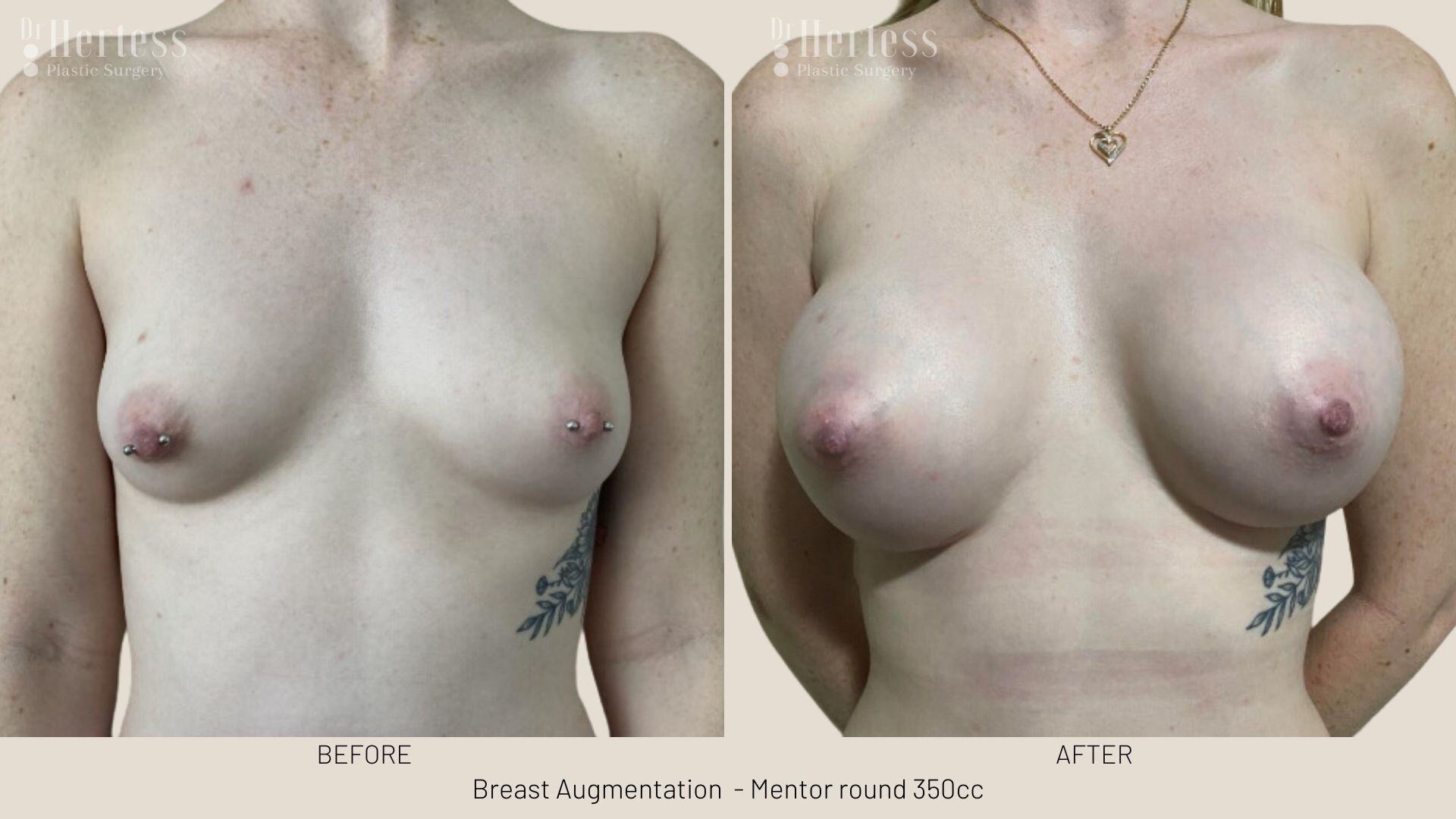 boob job photos before and after
