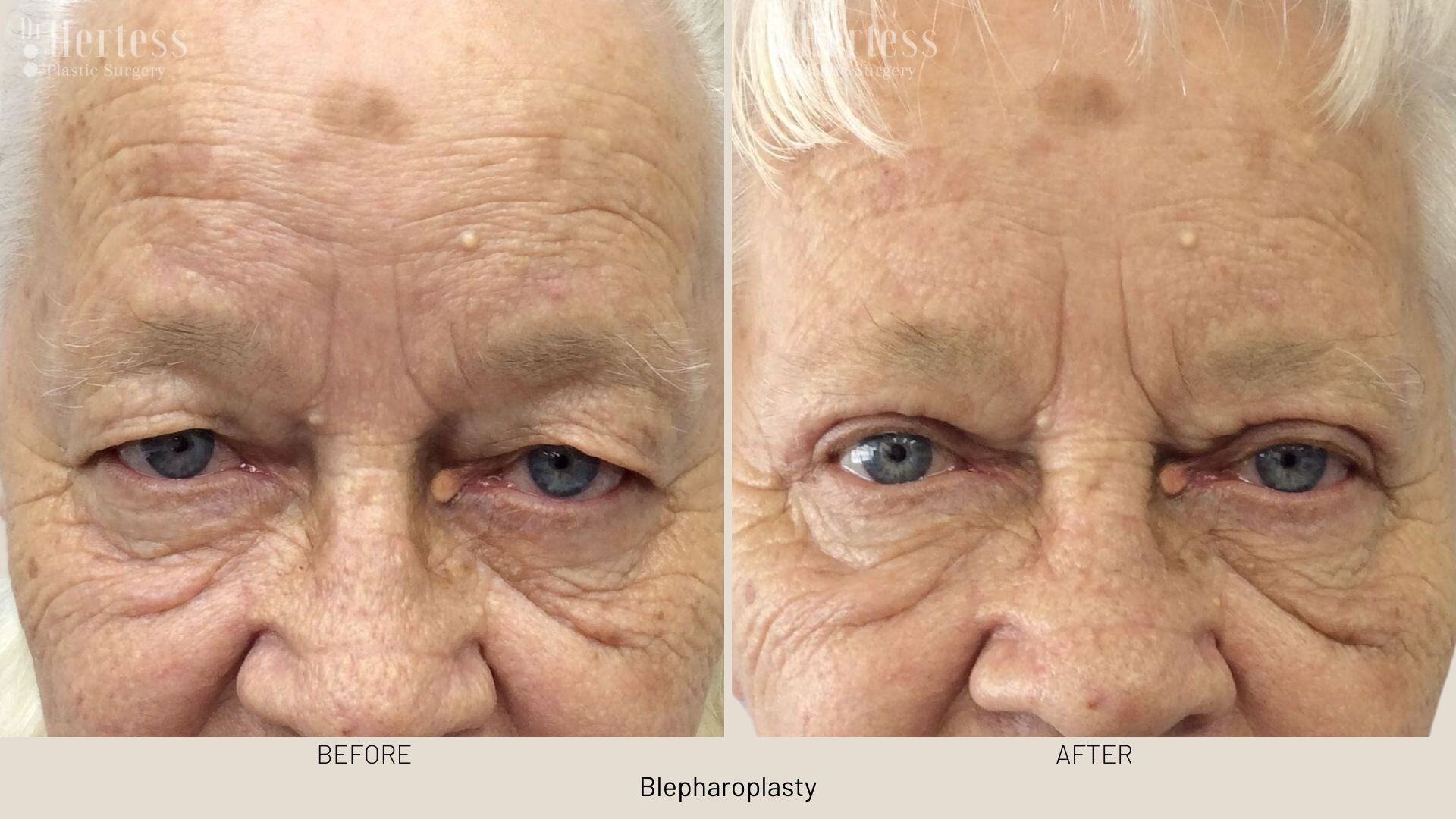 eyelid surgery before and after