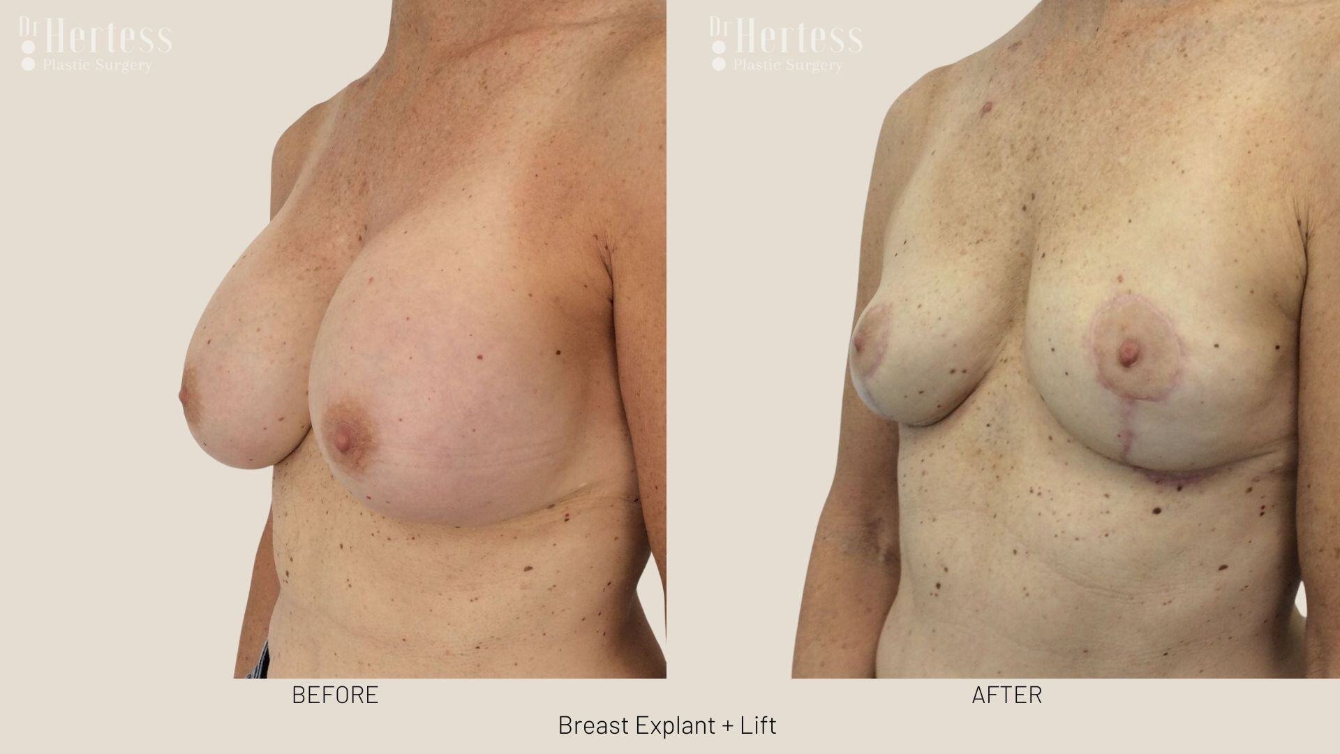 breast explant and lift photos
