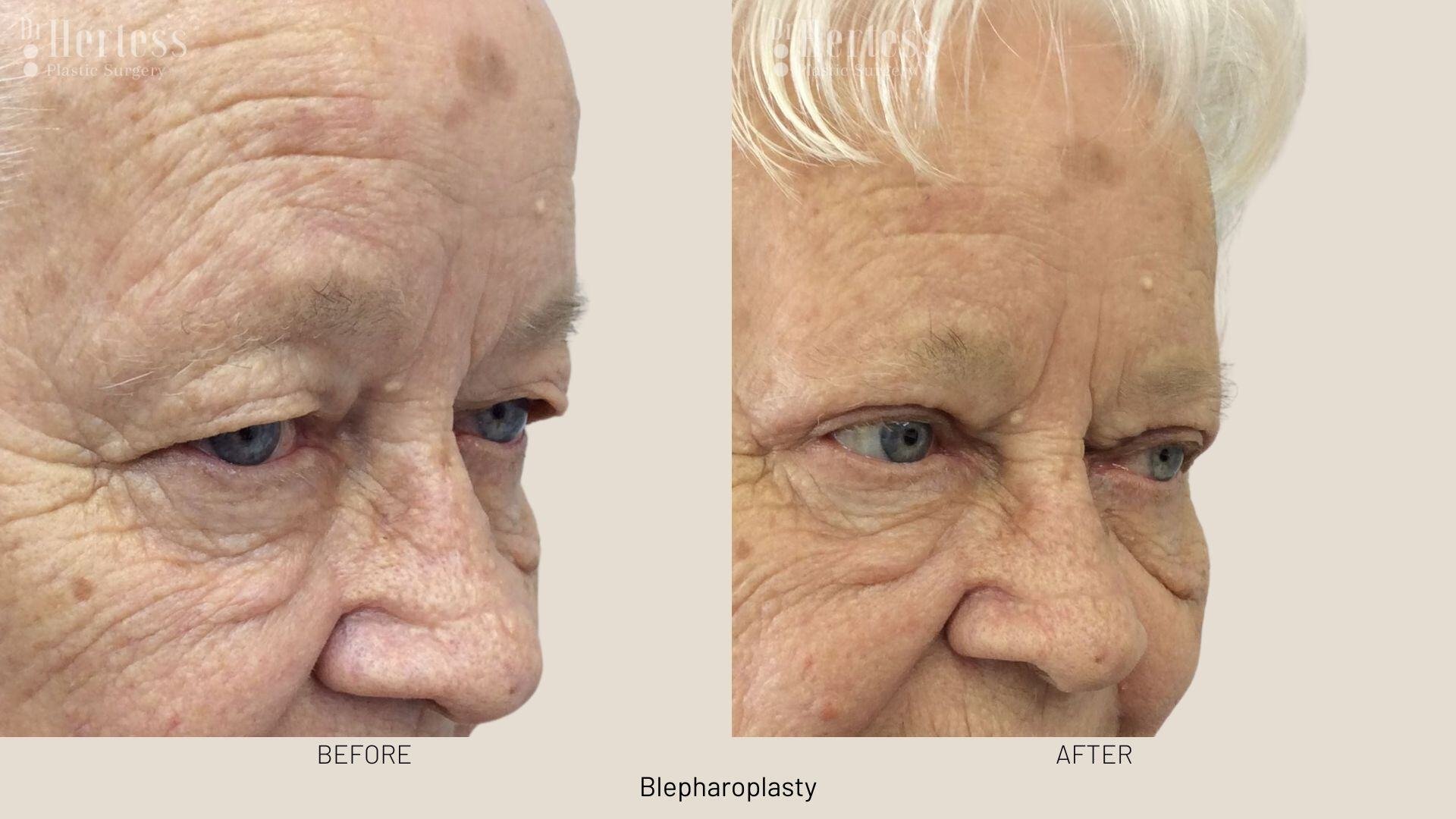 eyelid surgery before and after