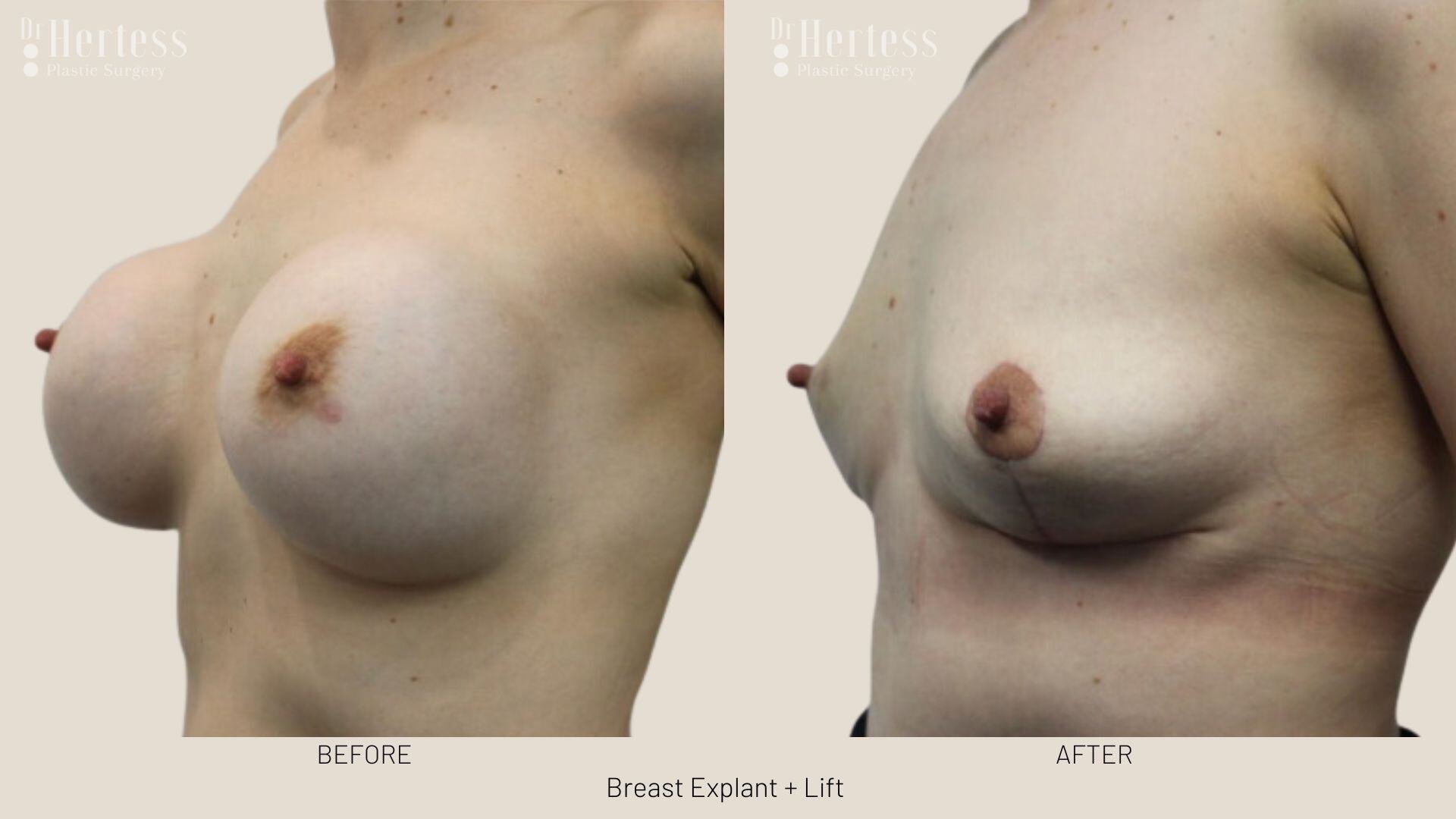 breast explant and lift photos