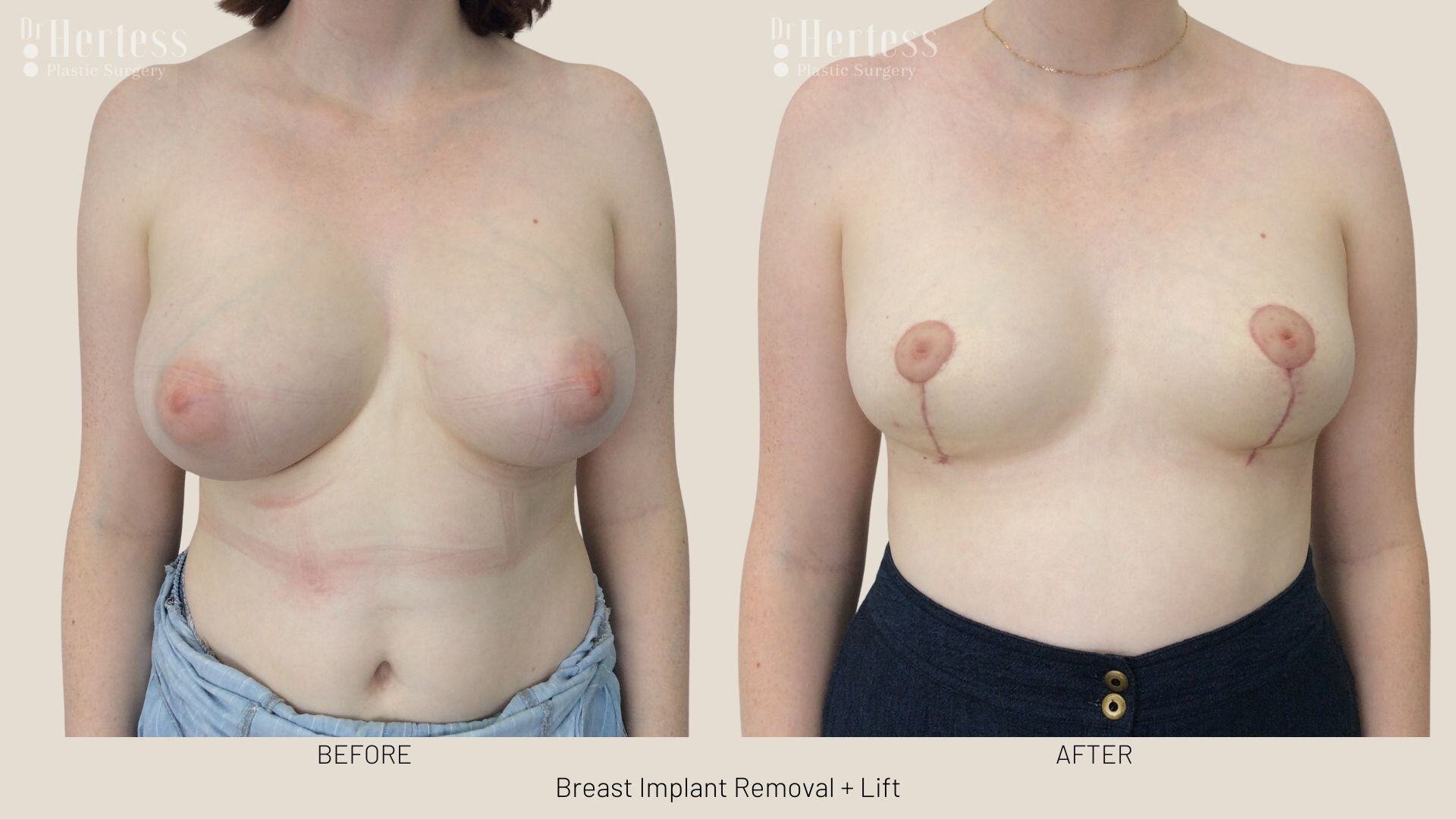 breast explant and lift photos