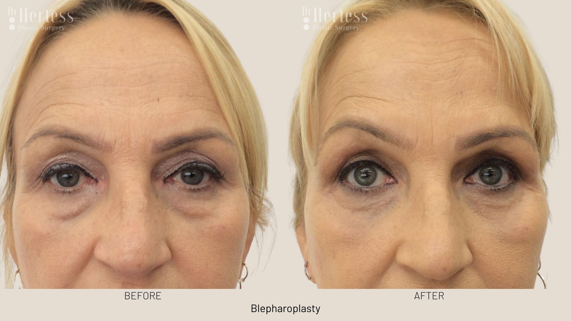 eyelid surgery before and after