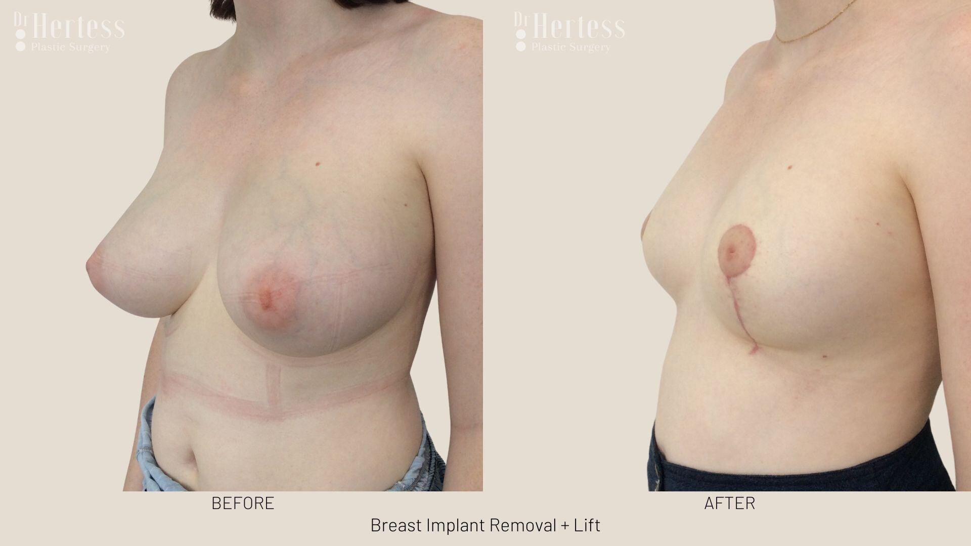 breast explant and lift photos