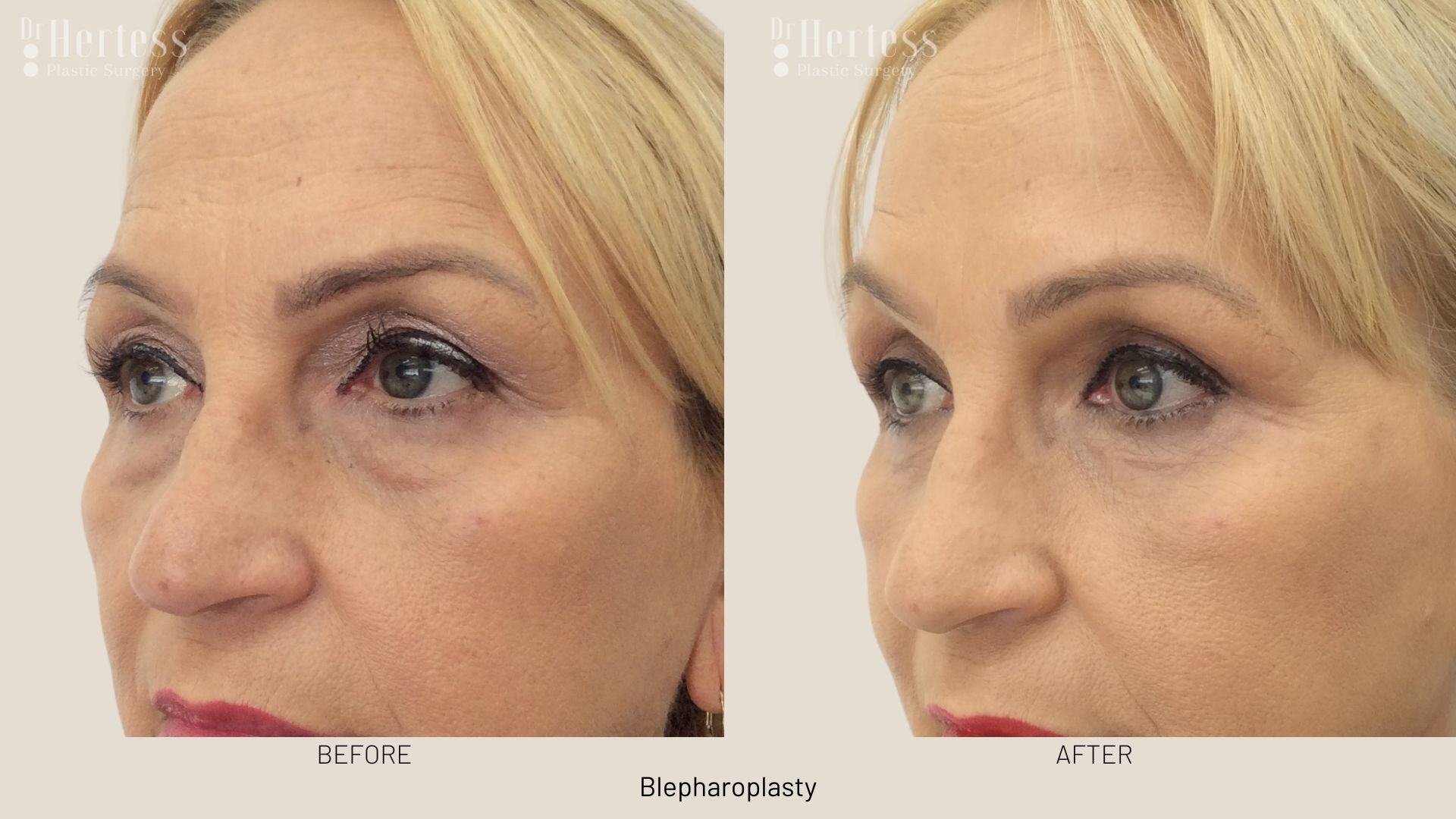 eyelid surgery before and after