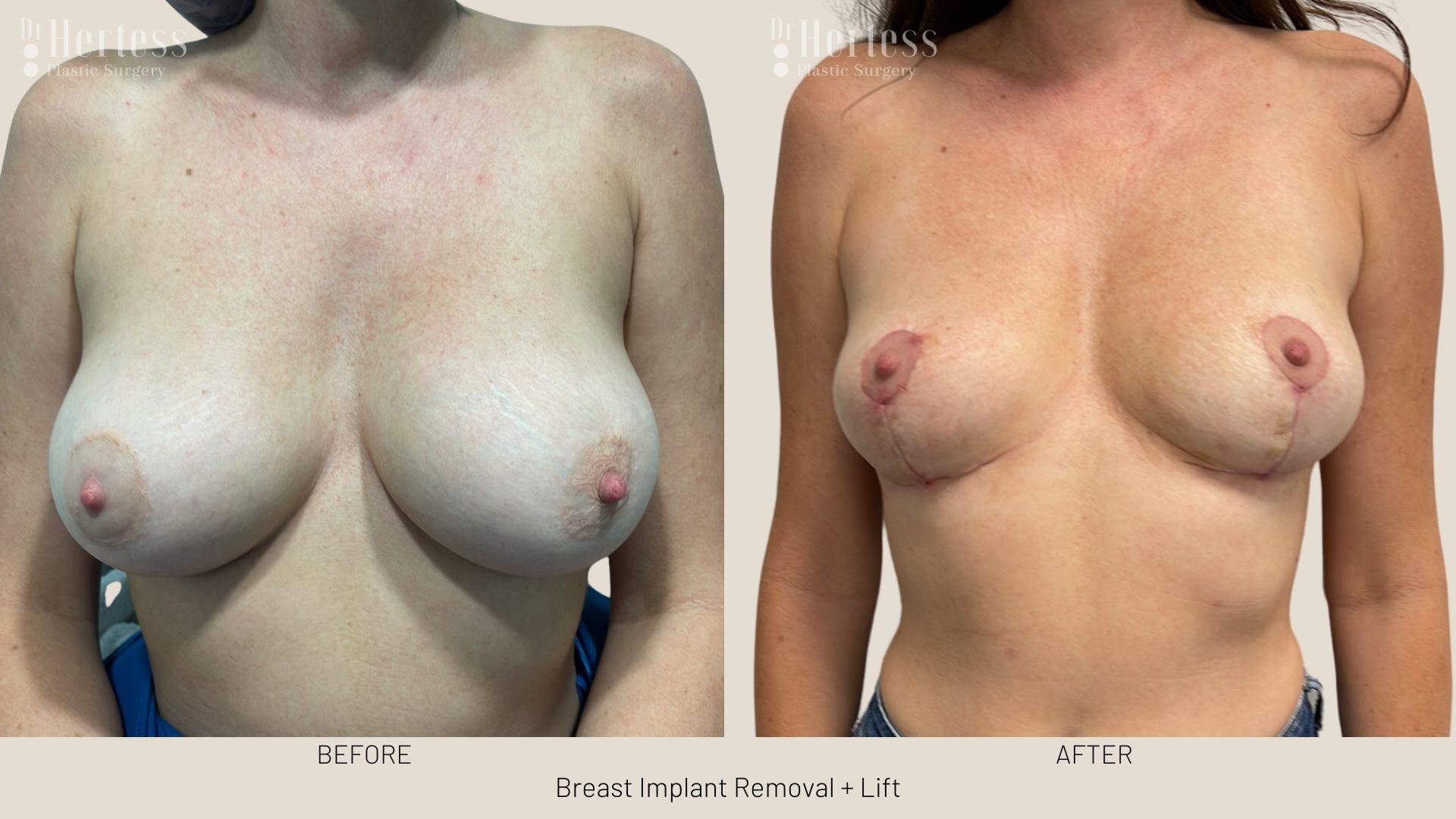 breast explant and lift photos