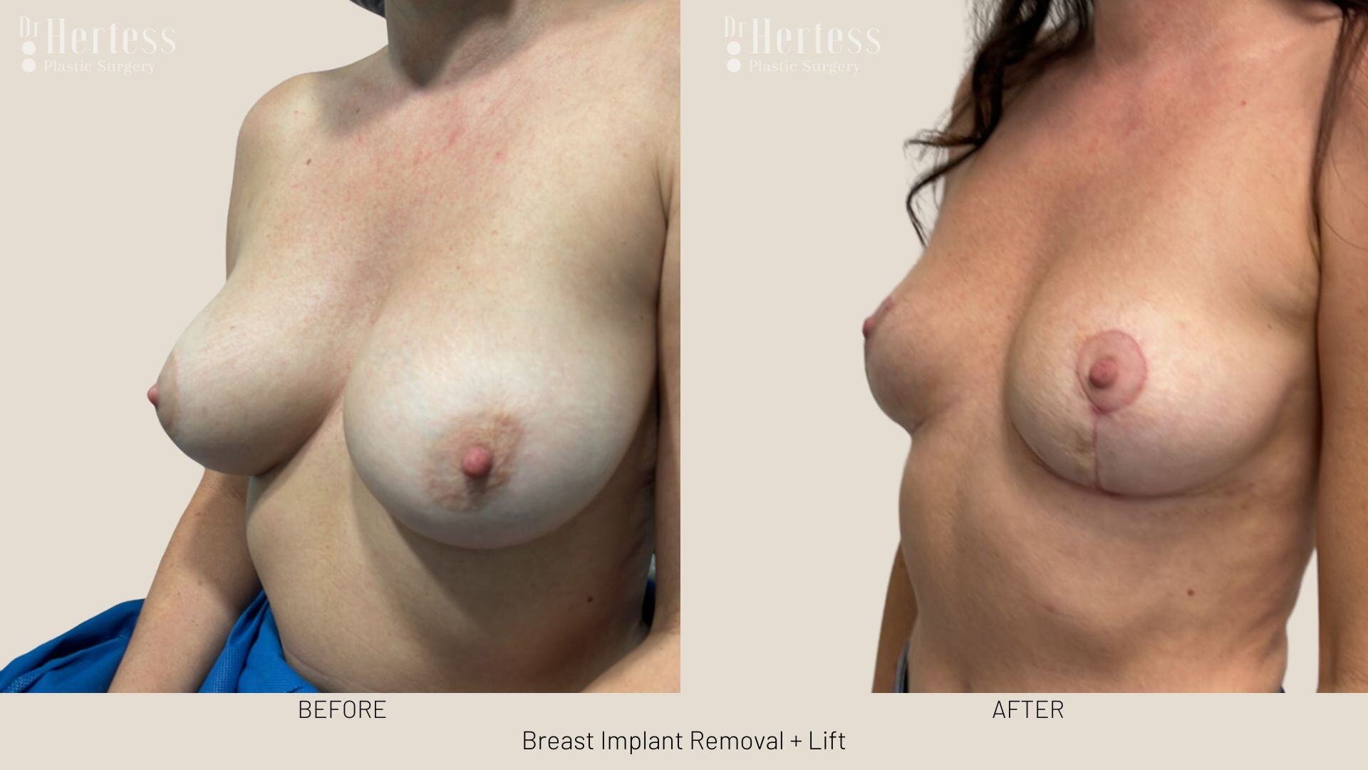 breast explant and lift photos