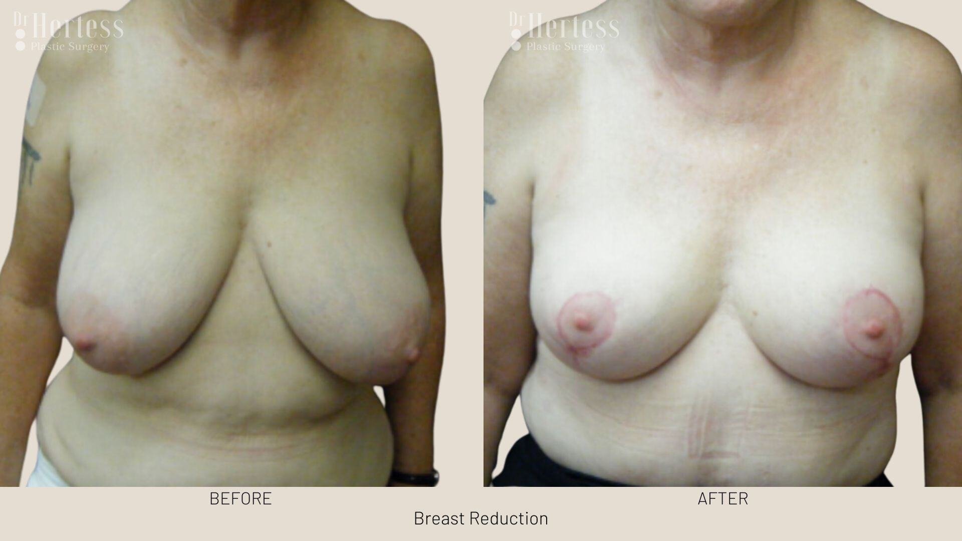 breast reduction before and after