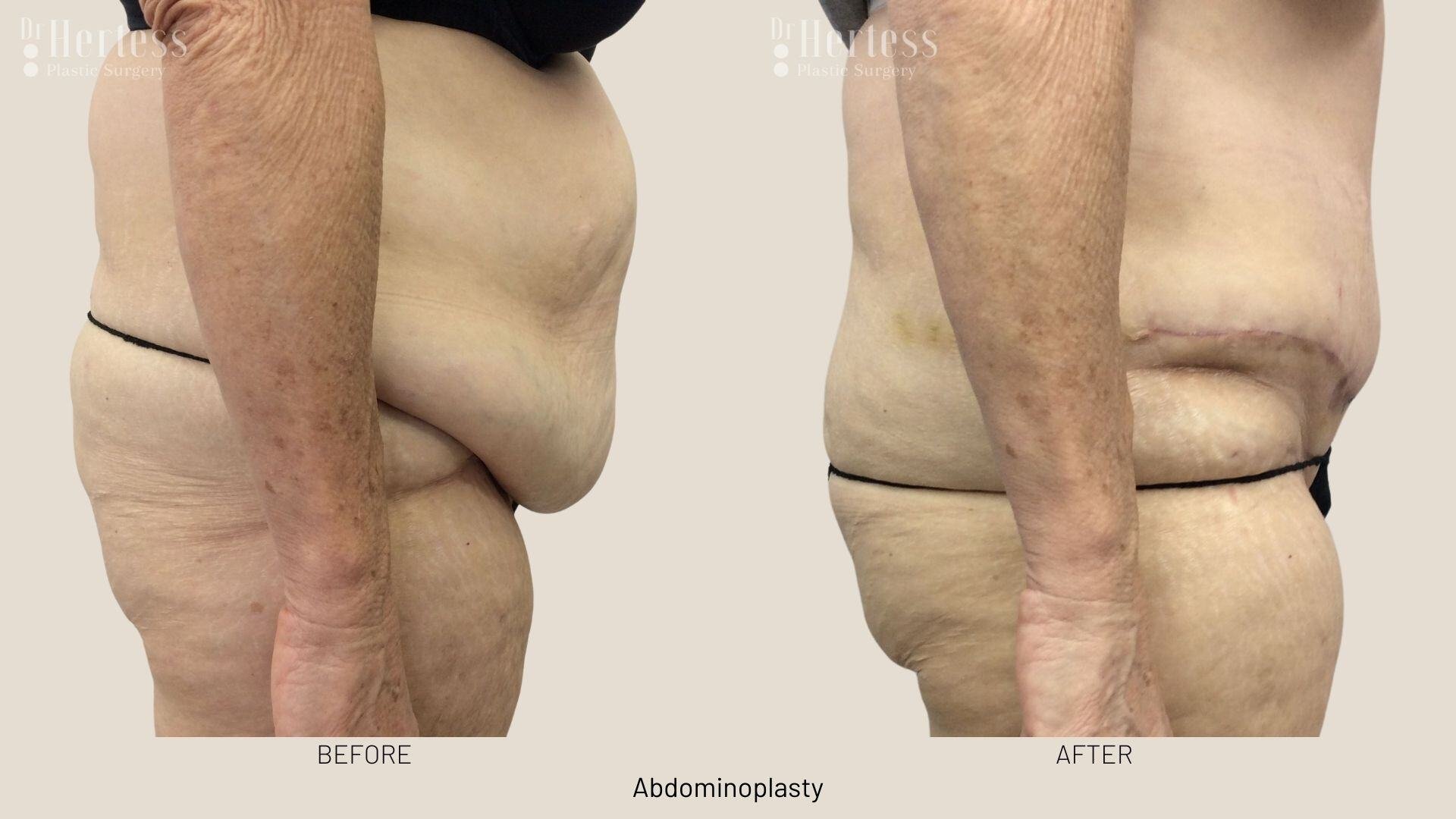 abdominoplasty before and after photos
