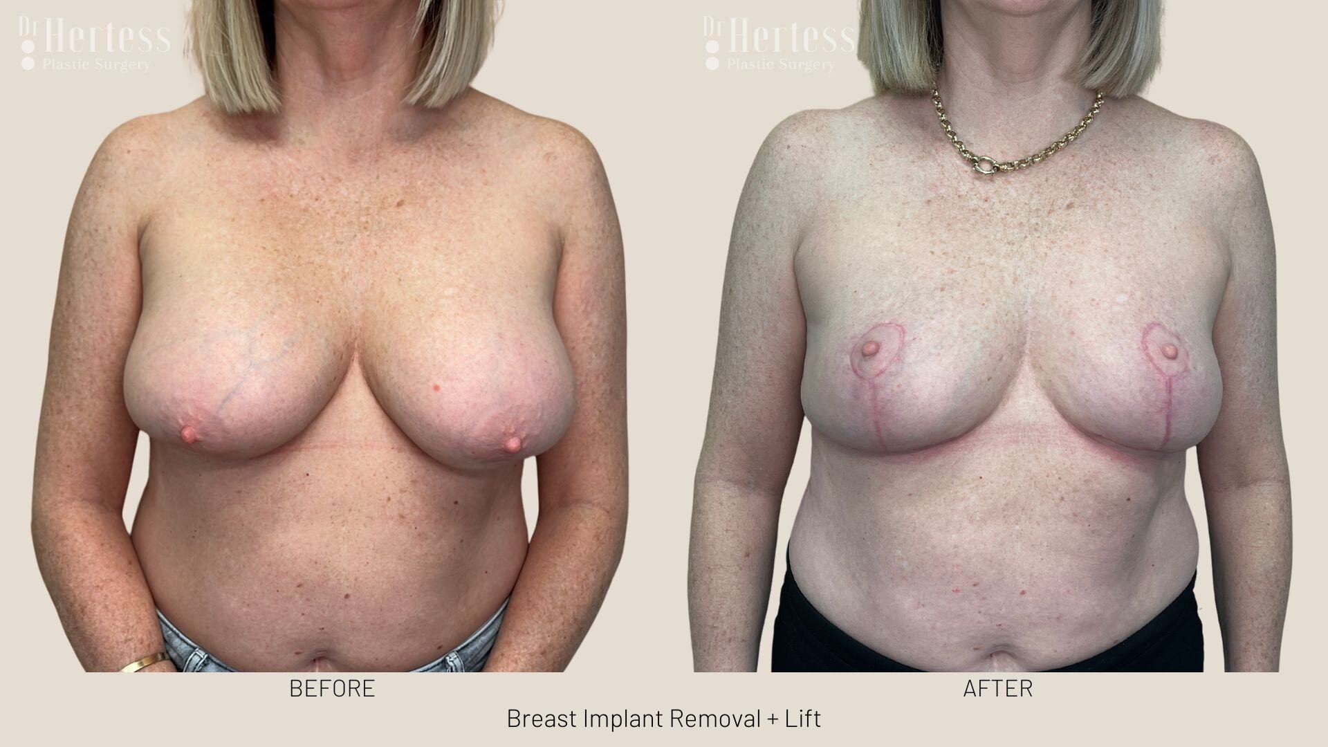 breast explant and lift photos