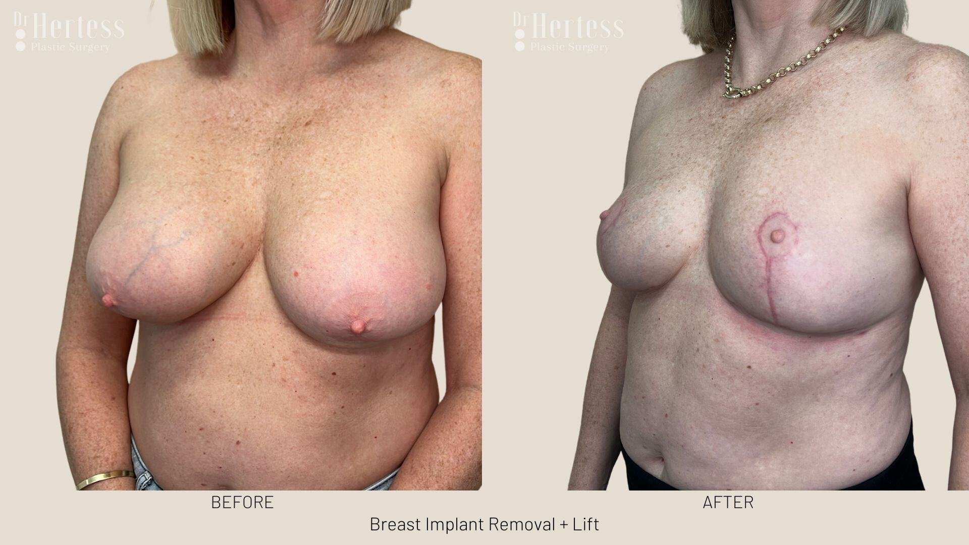 breast explant and lift photos