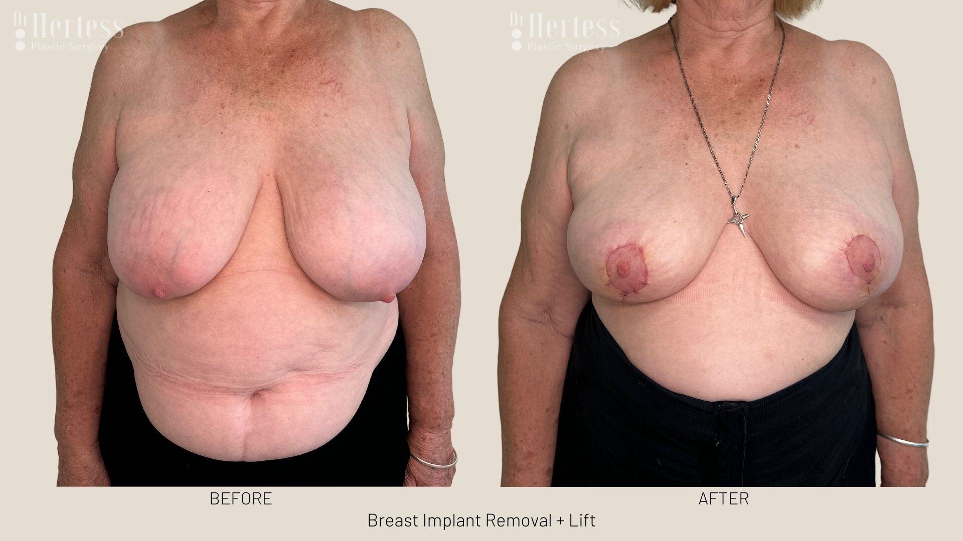 breast explant and lift photos