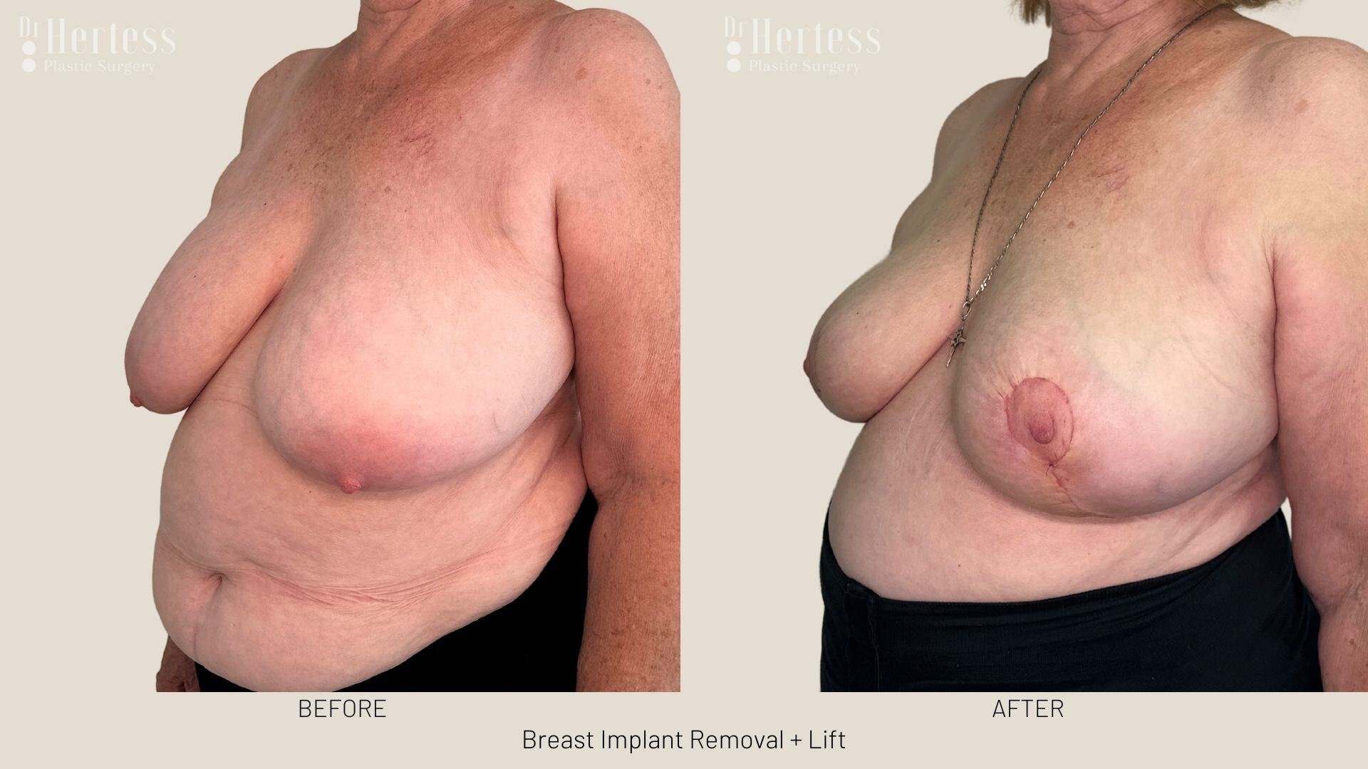breast explant and lift photos