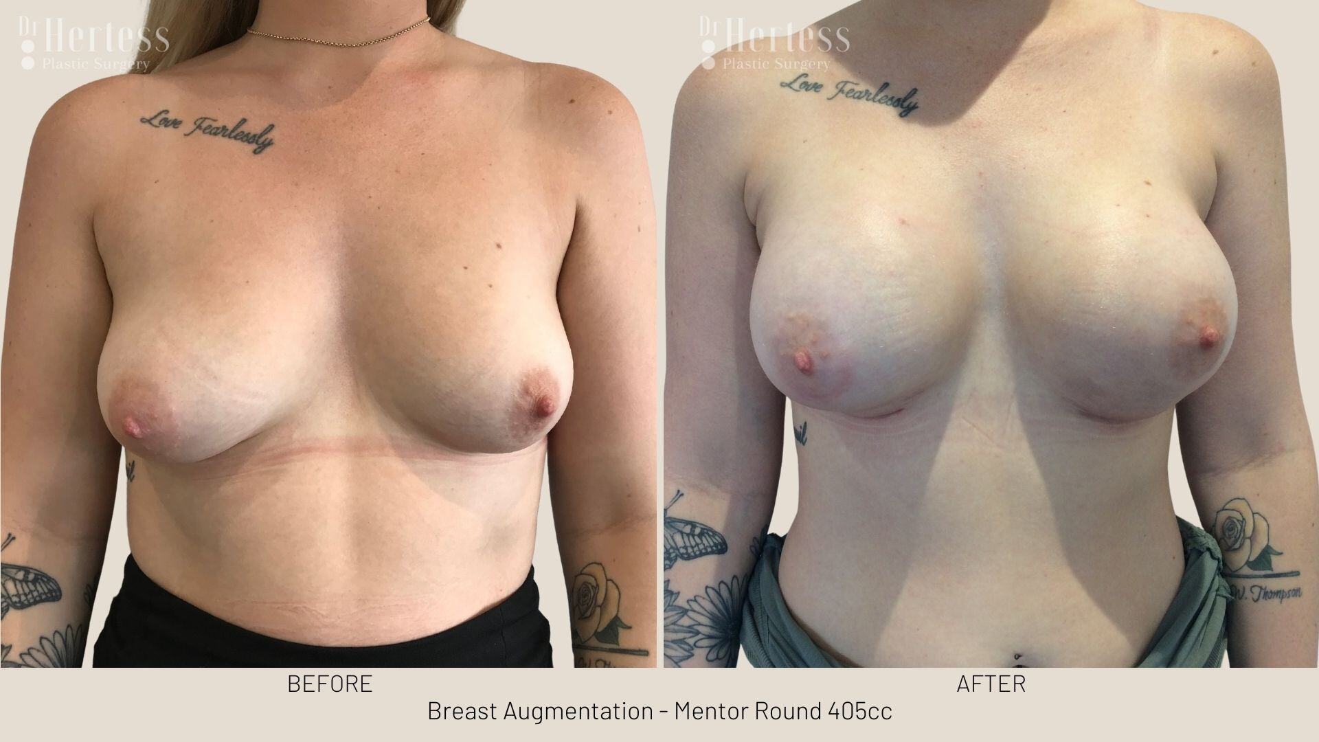 boob job photos before and after