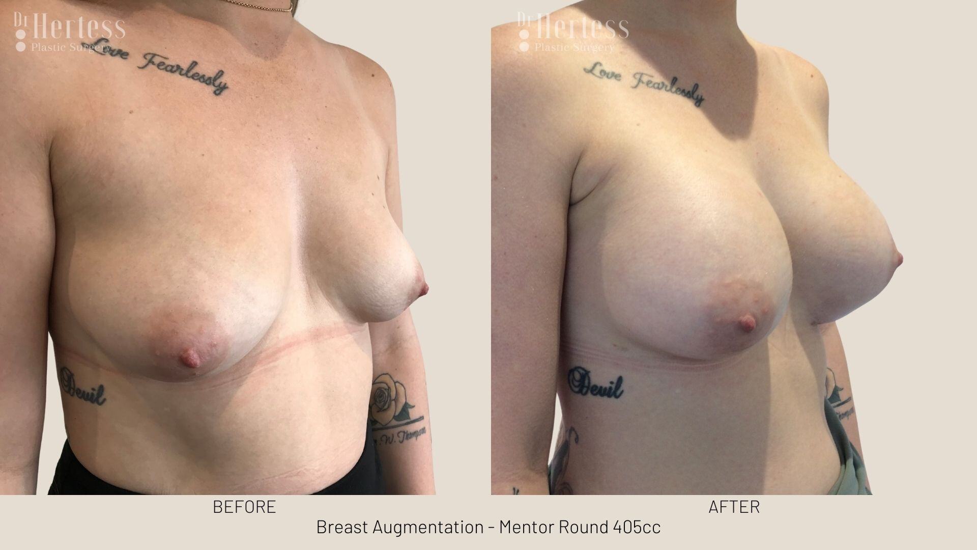 boob job photos before and after
