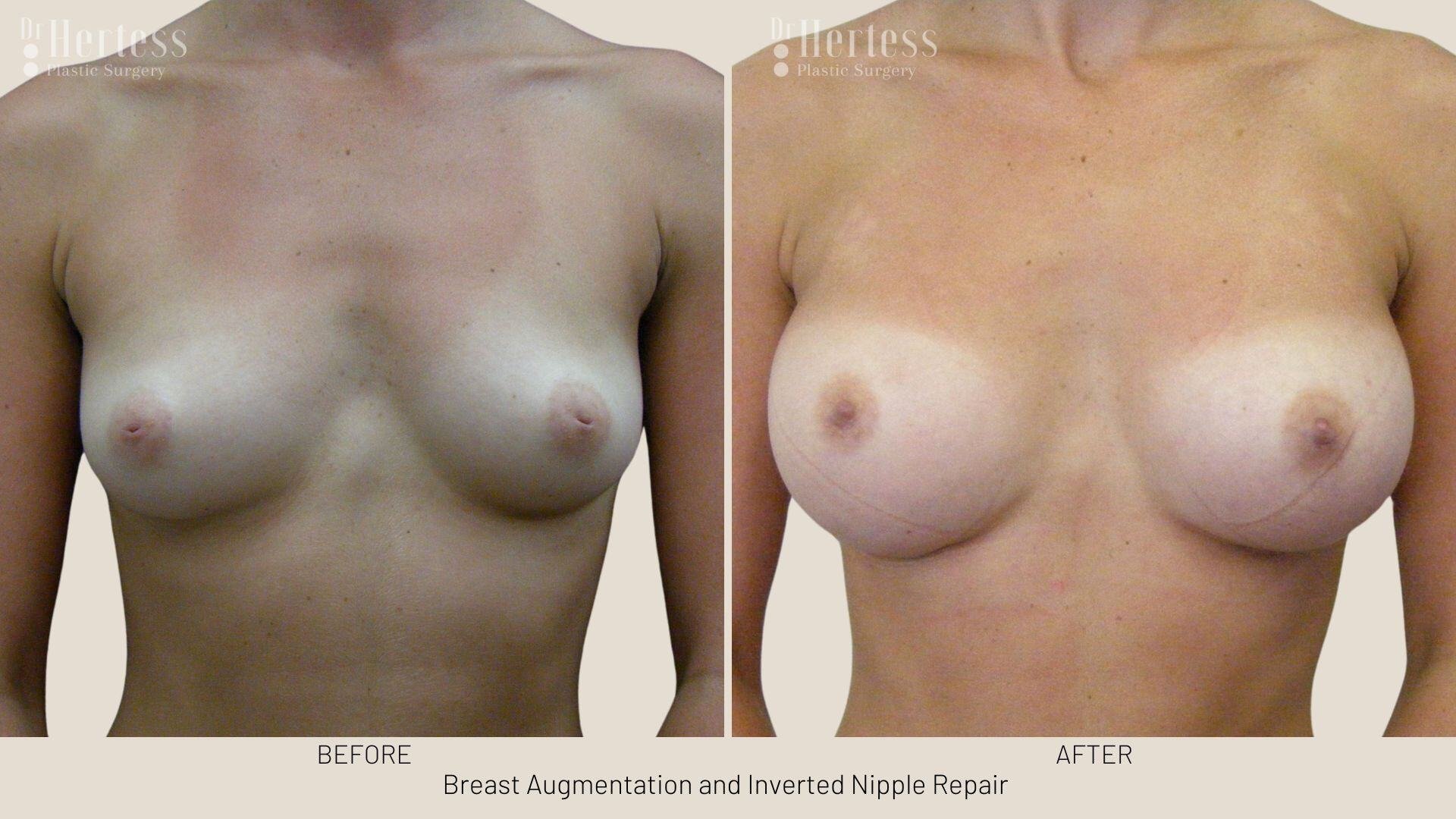 inverted nipple before after