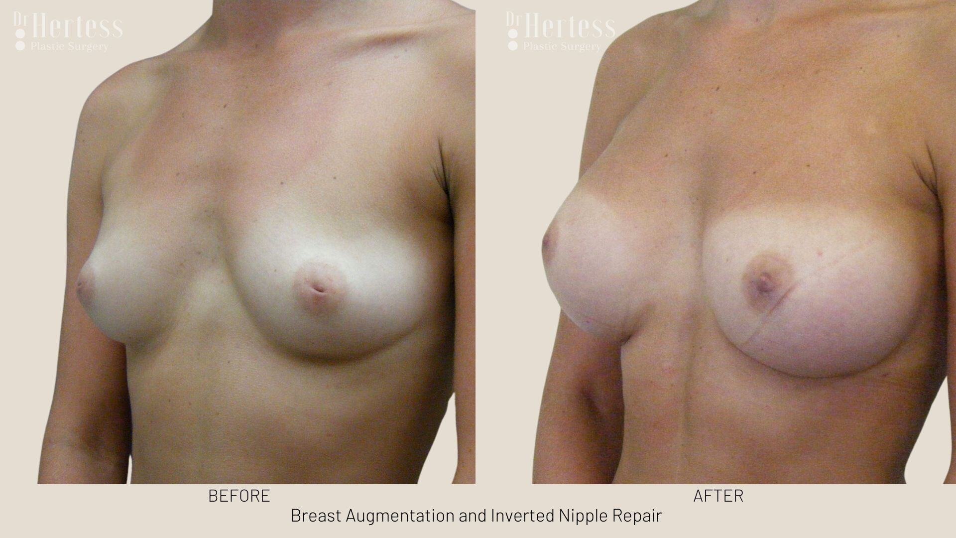 inverted nipple before after