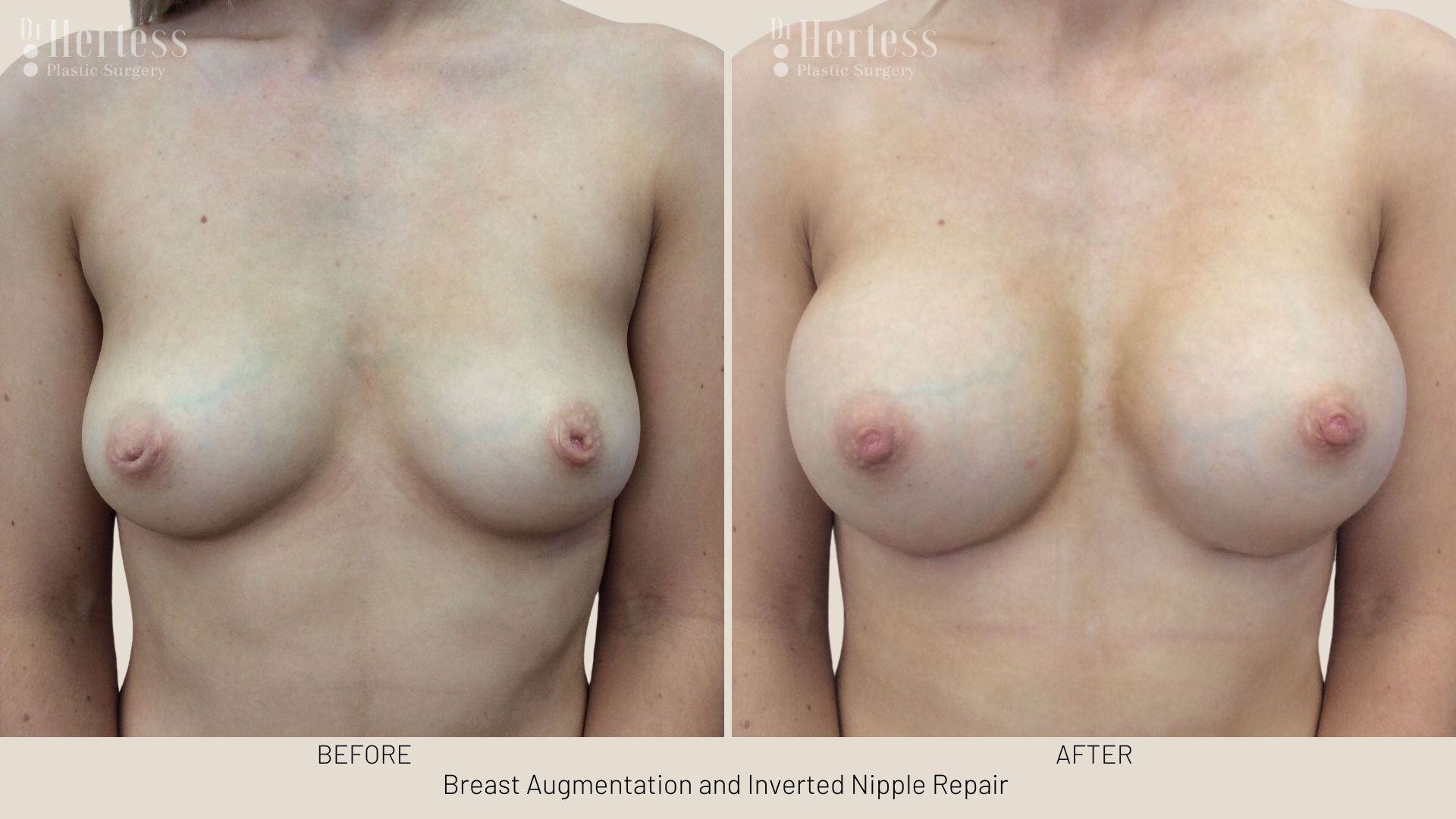 inverted nipple before after