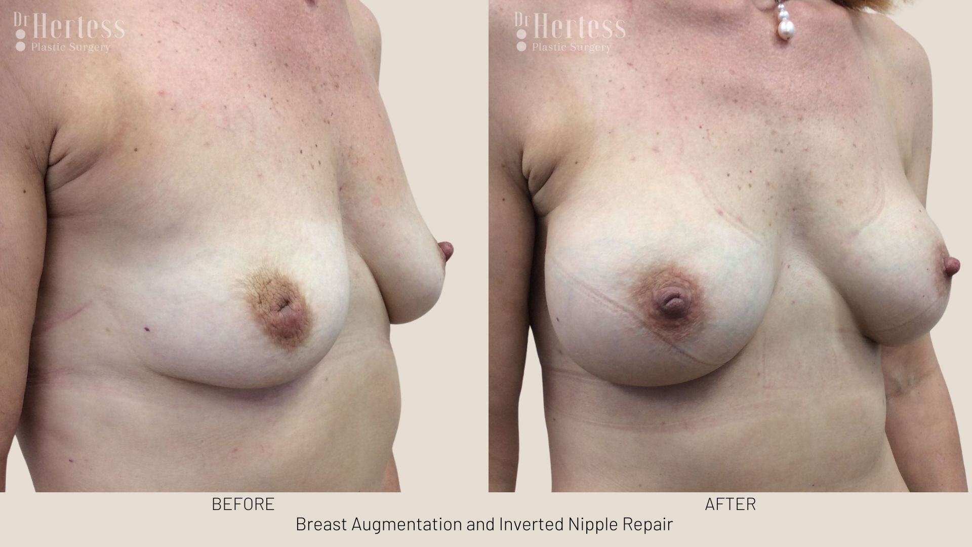 inverted nipple before after