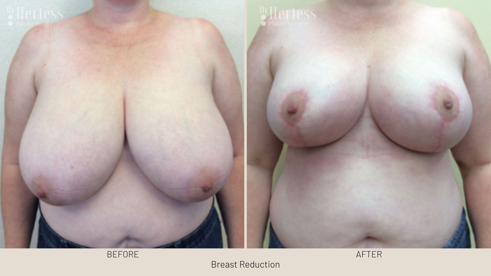 breast reduction before and after