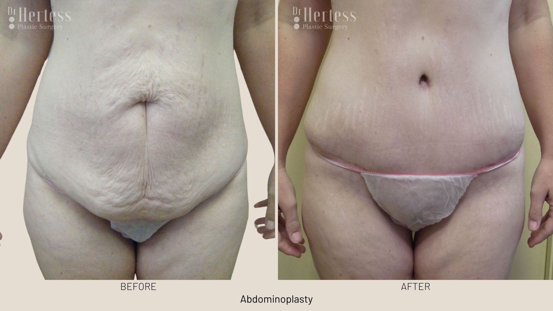 abdominoplasty before and after photos