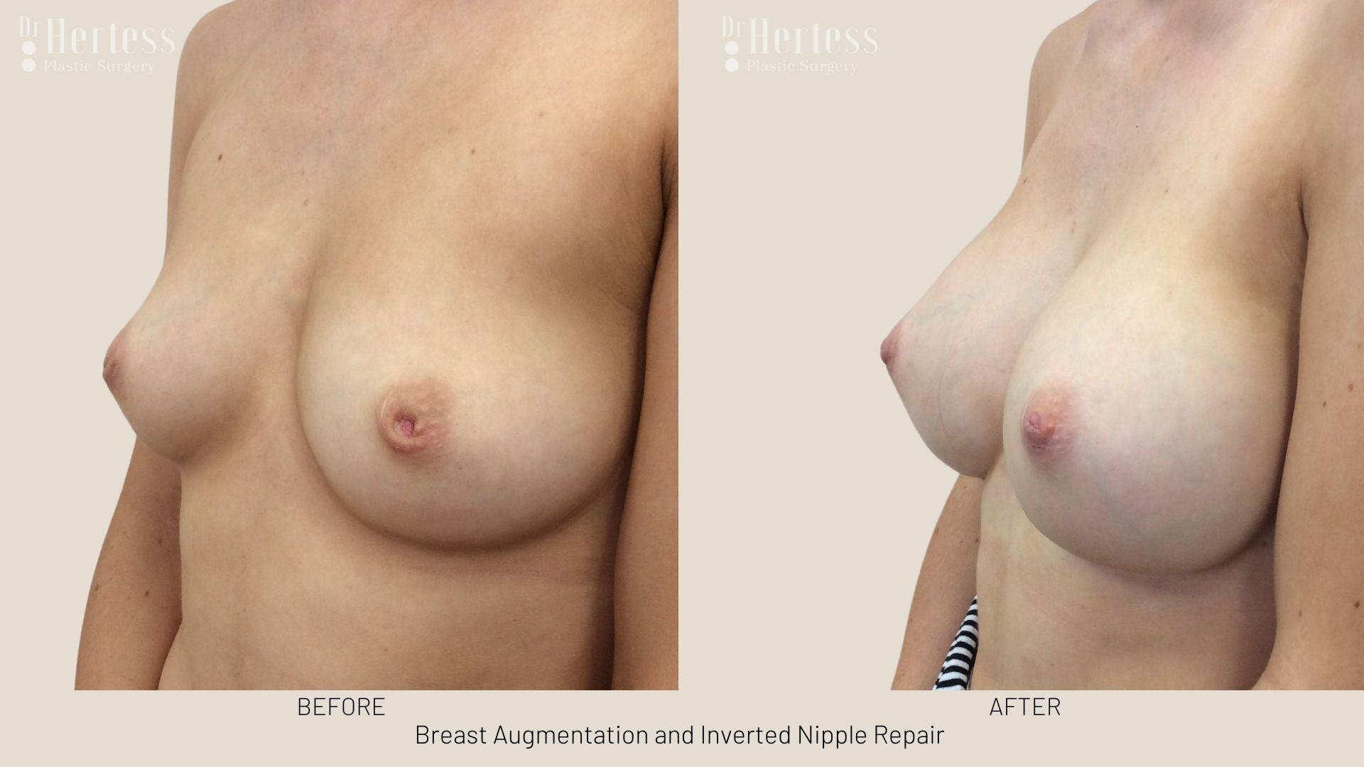 inverted nipple before after