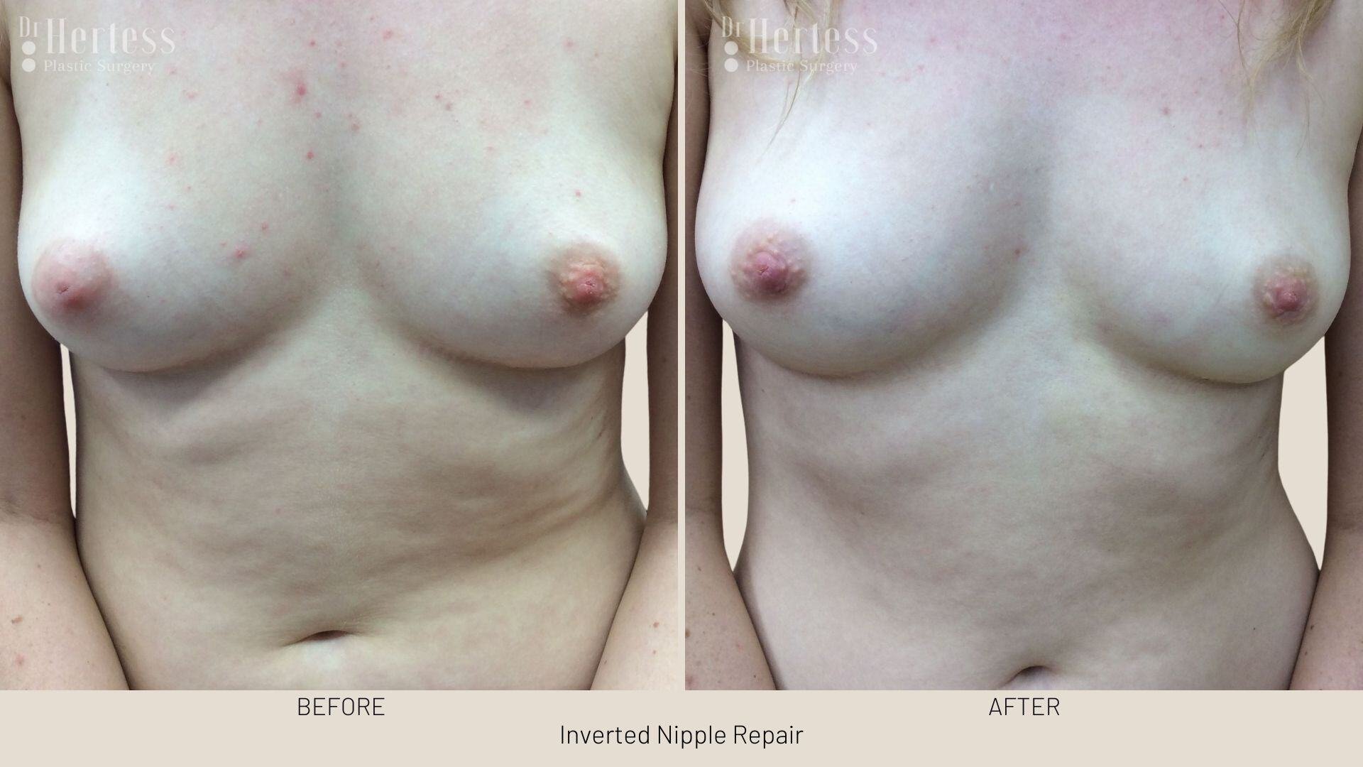 inverted nipple before after