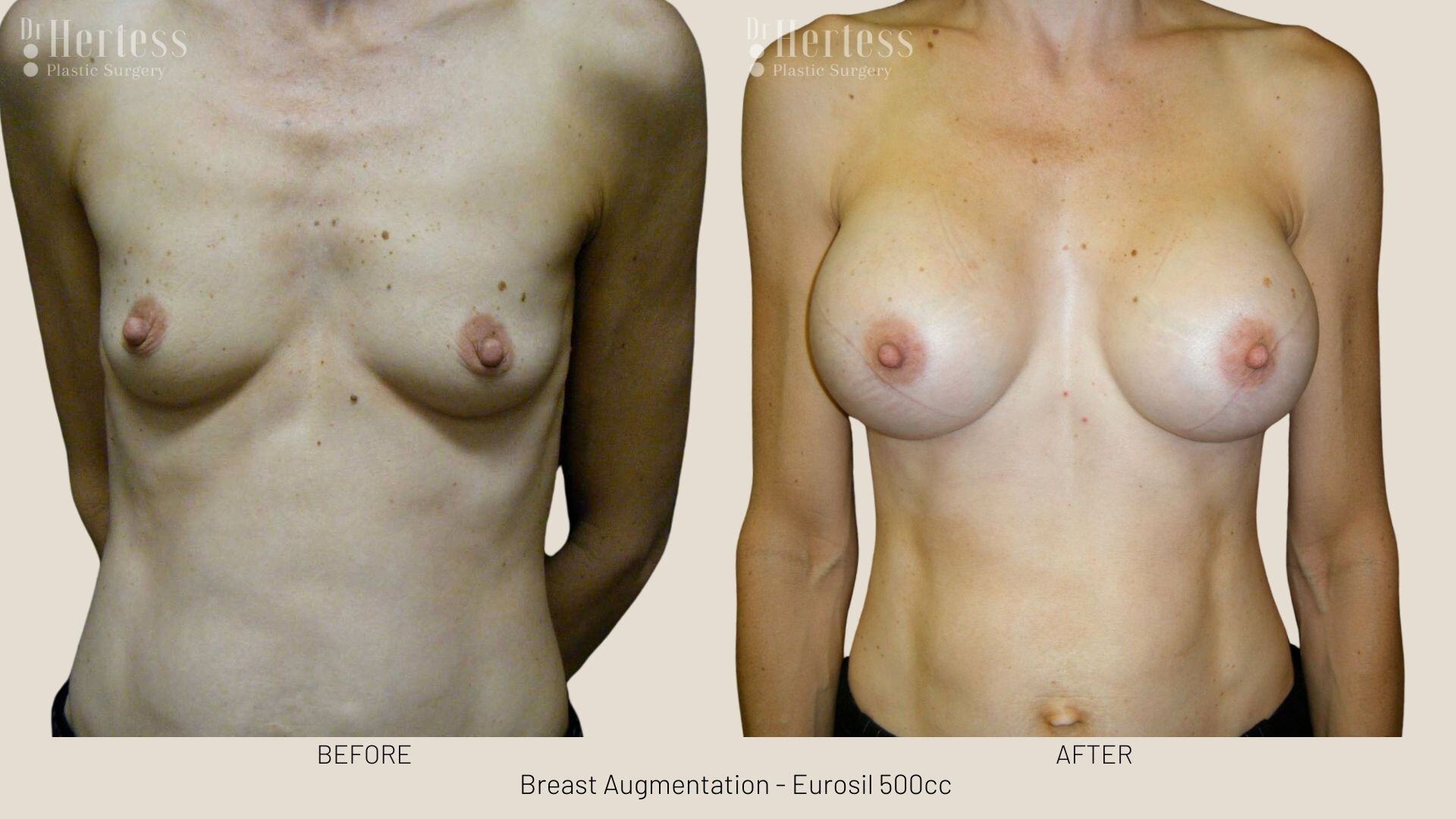 boob job photos before and after