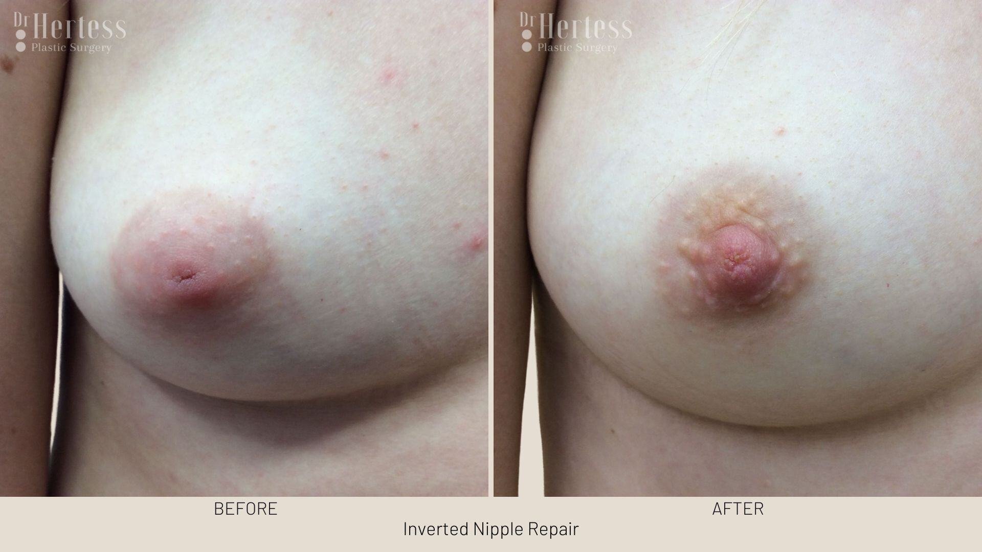 inverted nipple before after