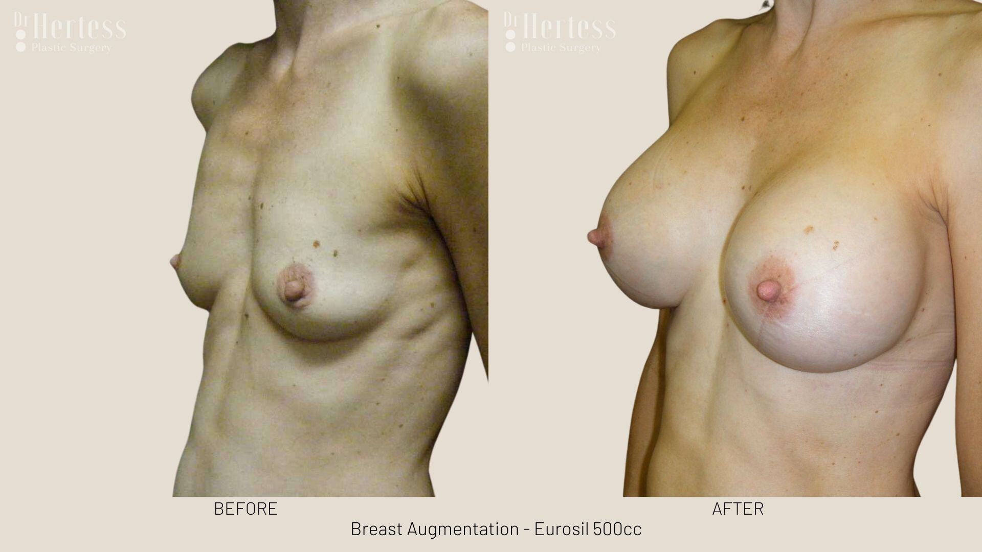 boob job photos before and after