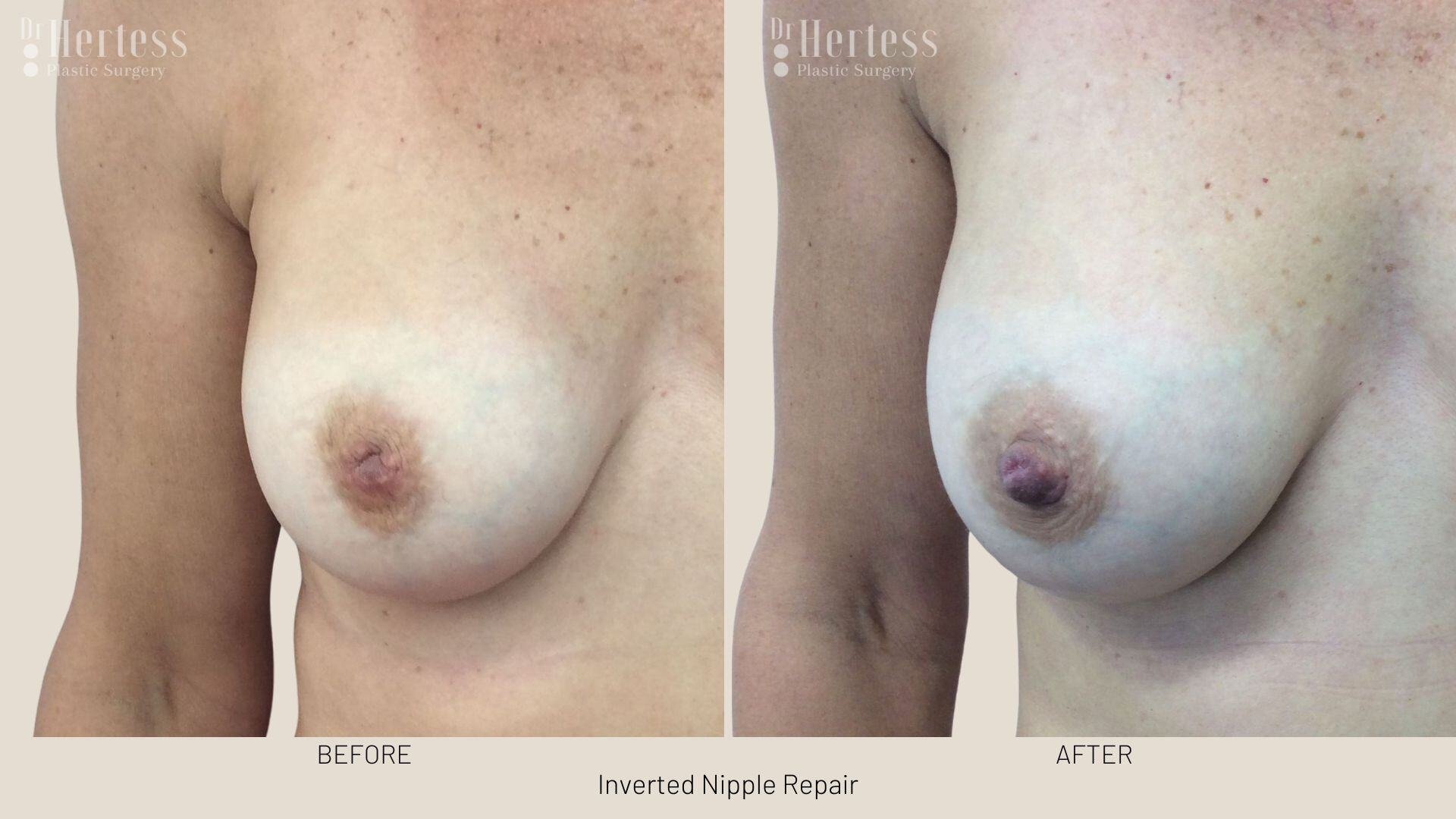 inverted nipple before after