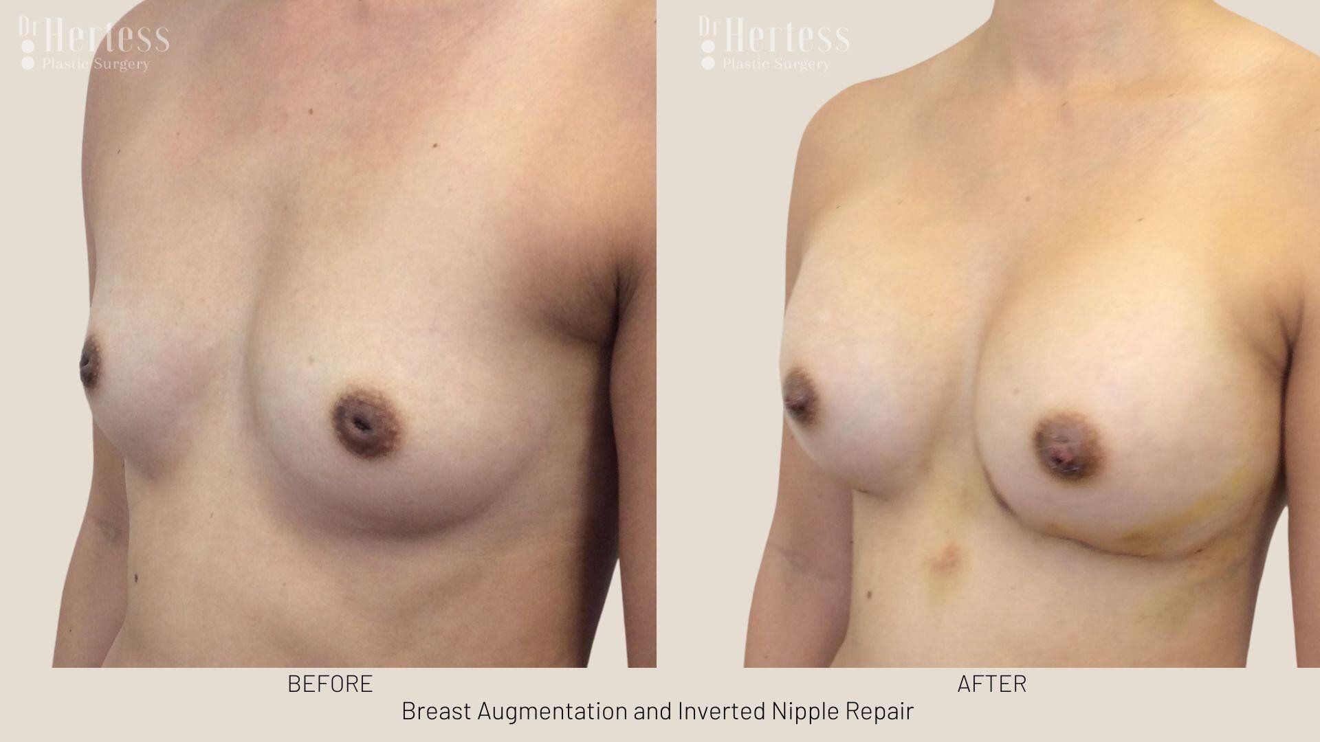 inverted nipple before after