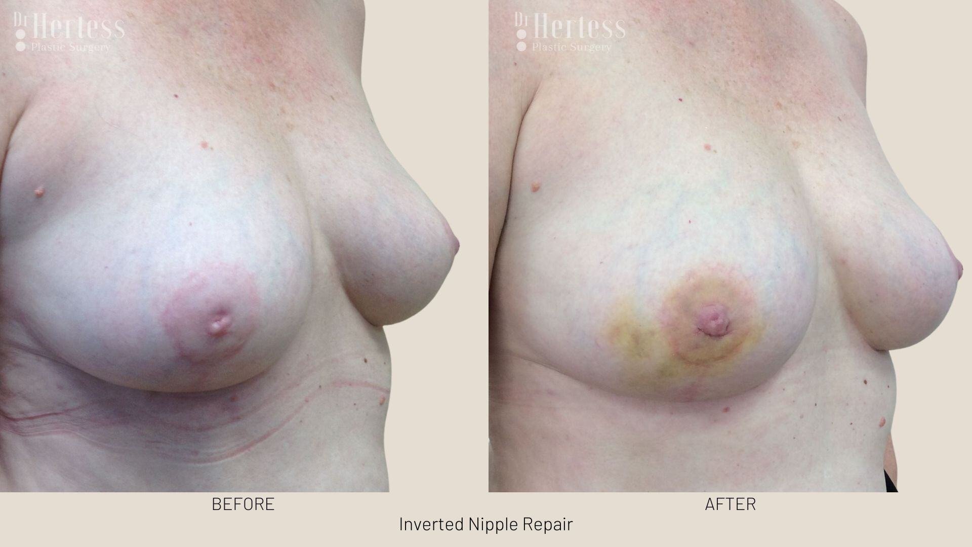 inverted nipple before after