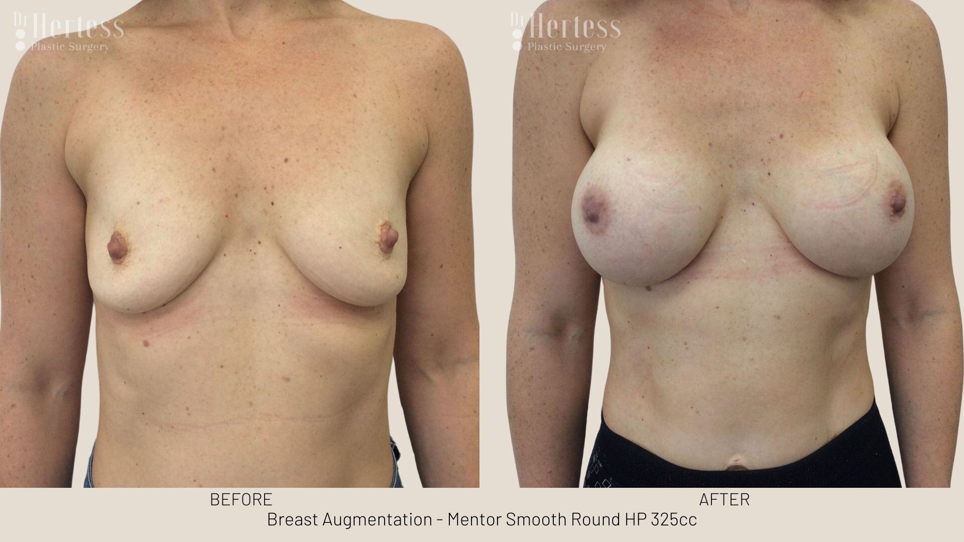 breast augmentation photos before and after