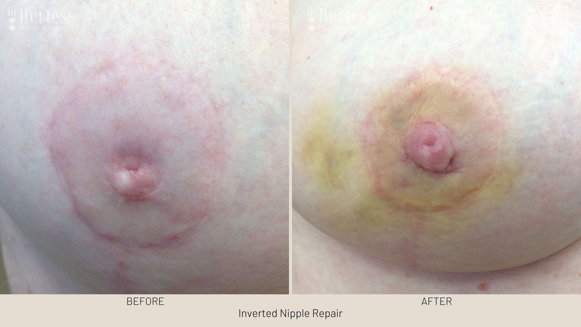 inverted nipple before after