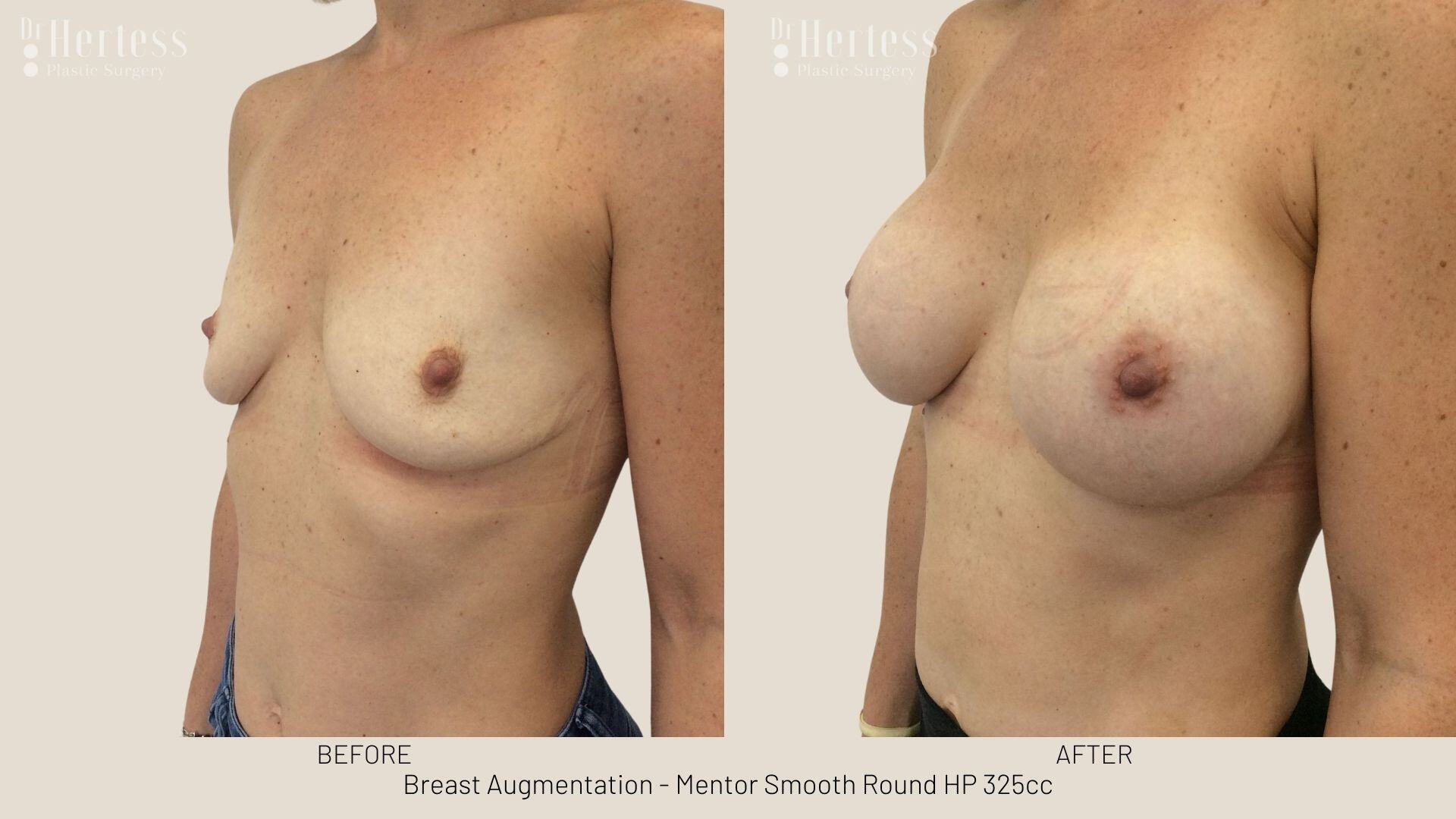 breast augmentation photos before and after