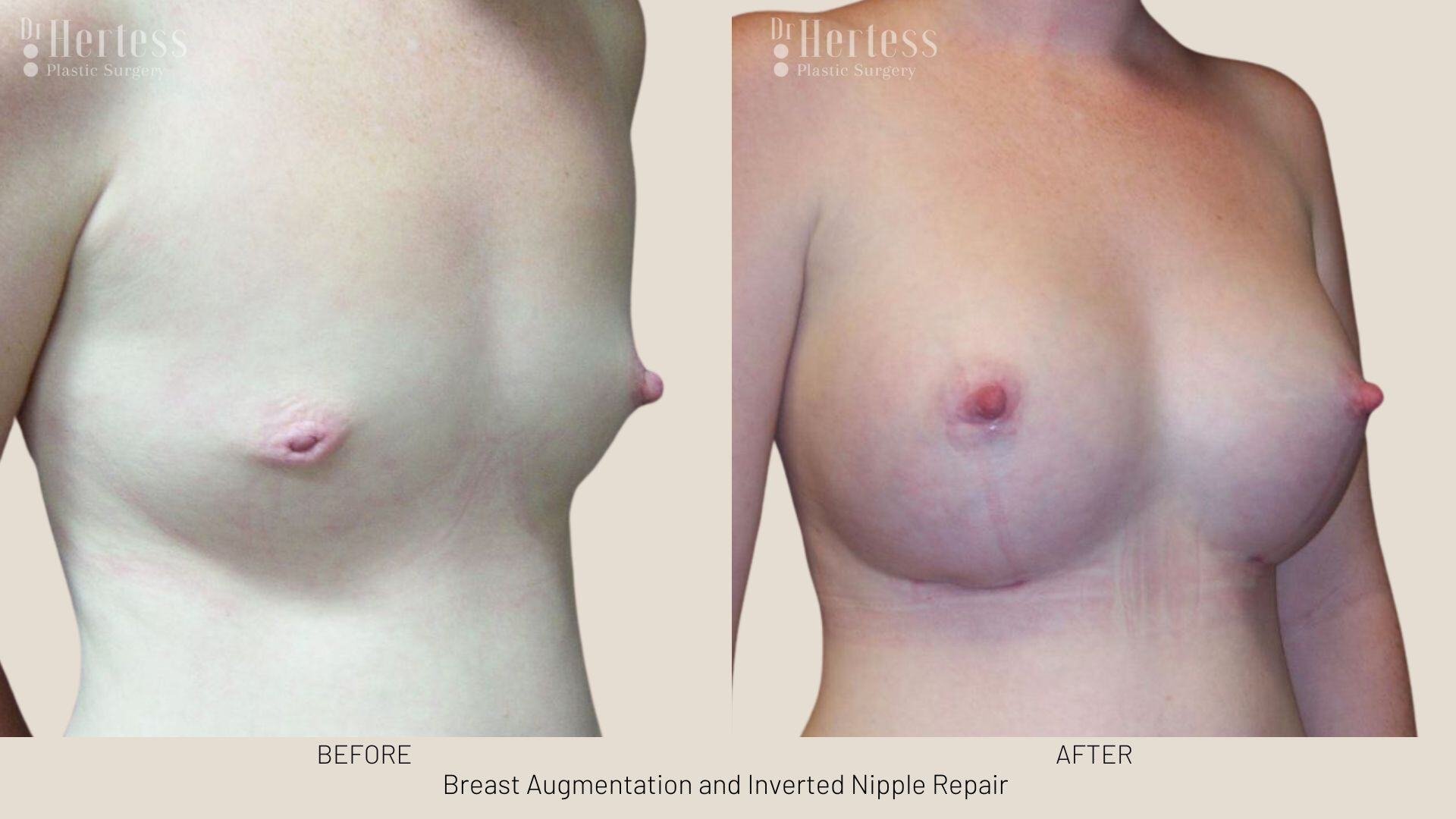 inverted nipple before after