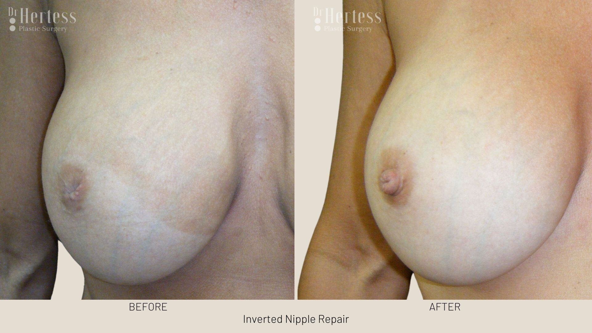 inverted nipple before after