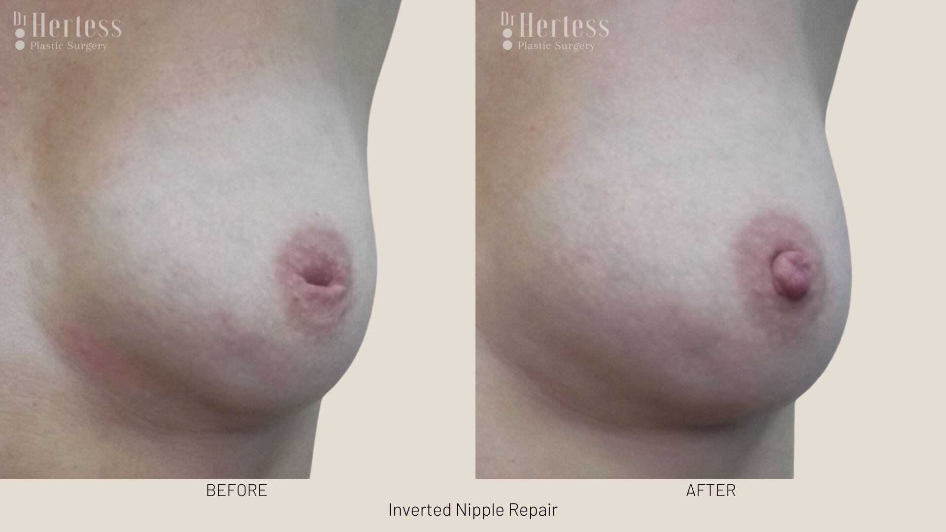 inverted nipple before after
