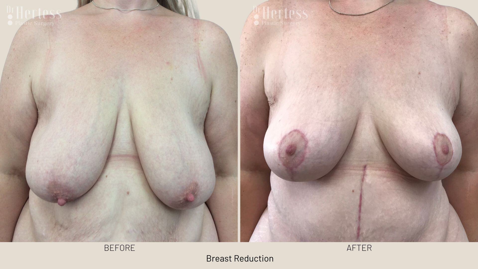 breast reduction before and after