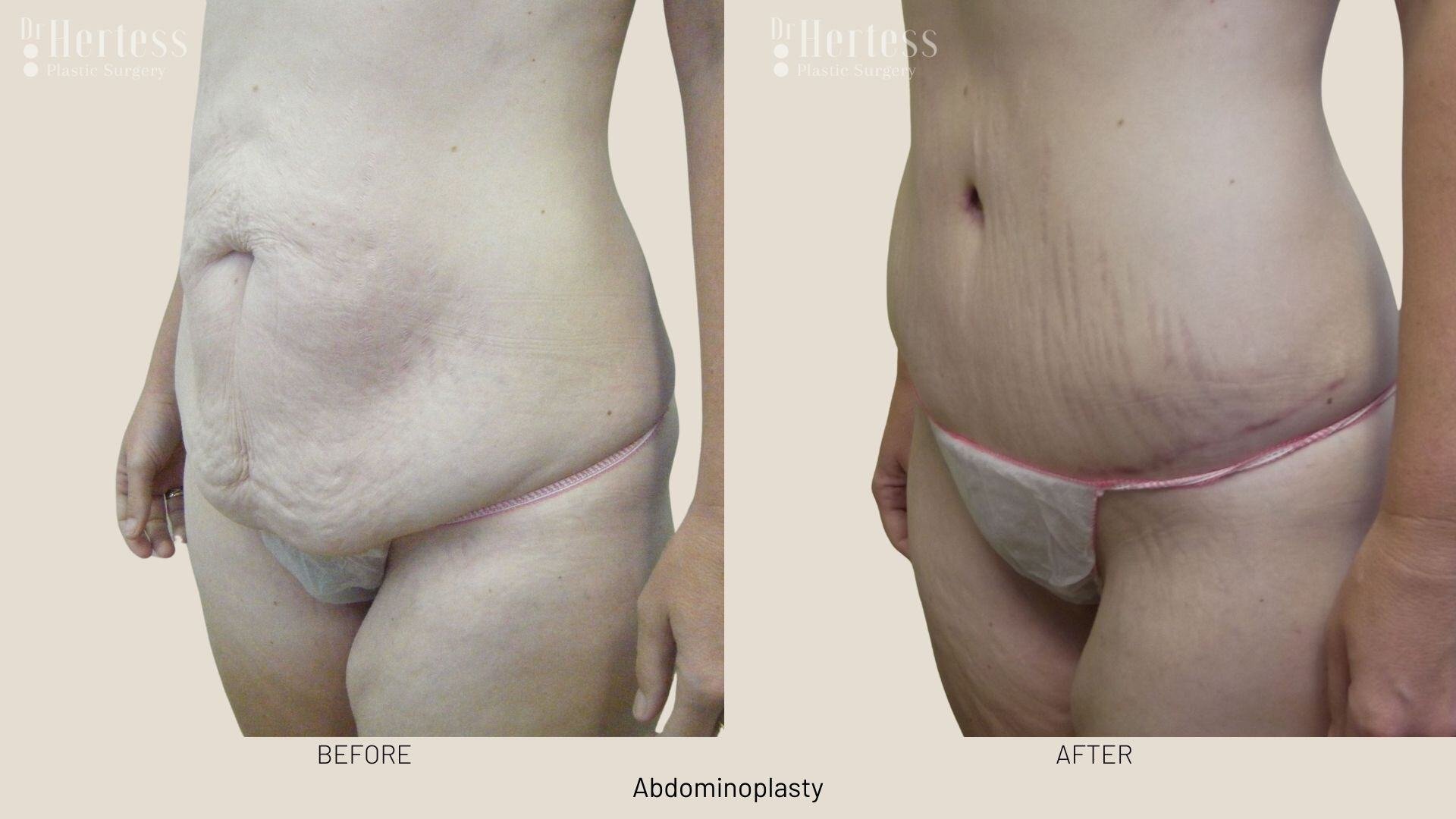 abdominoplasty before and after photos