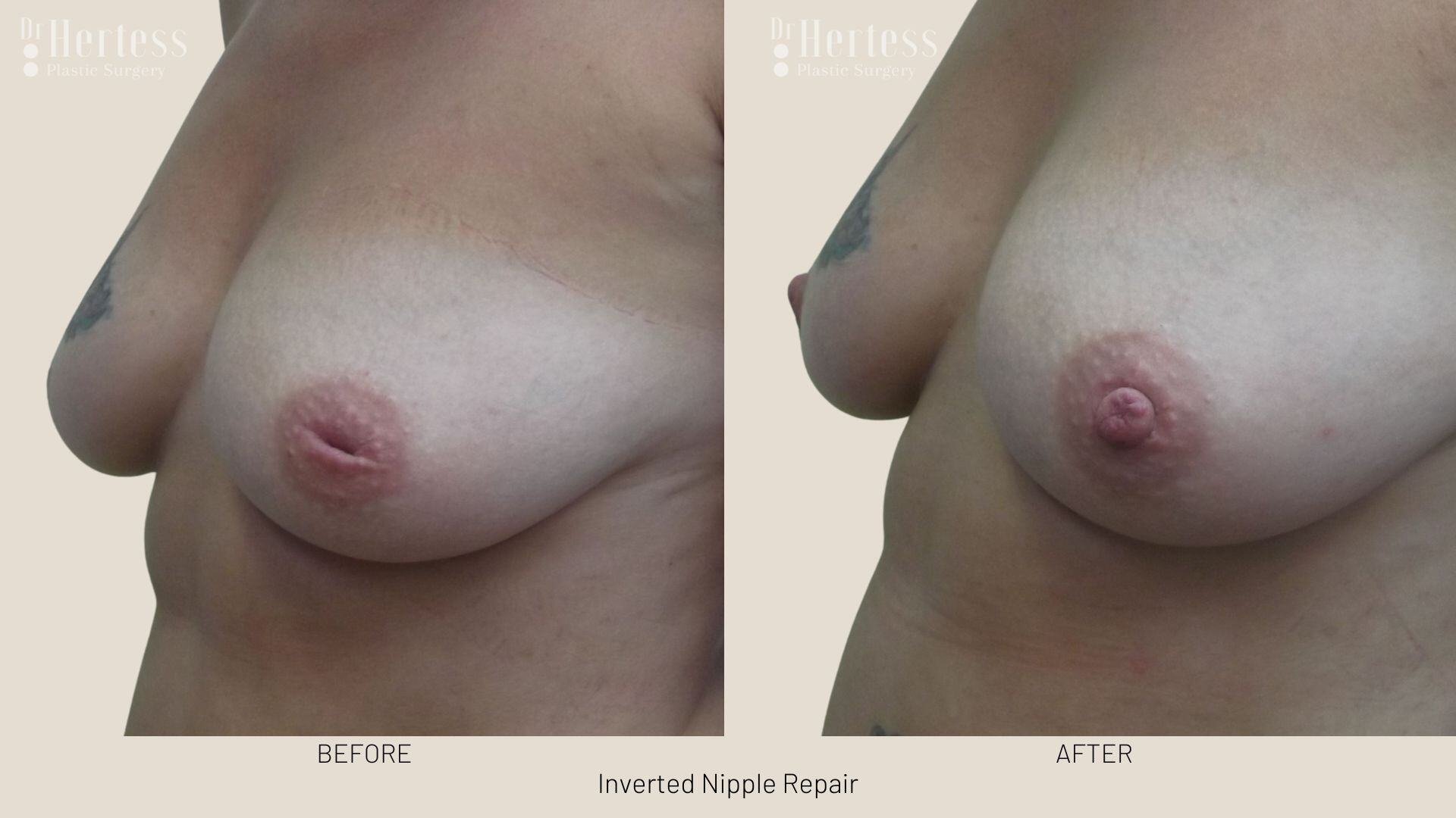 inverted nipple before after