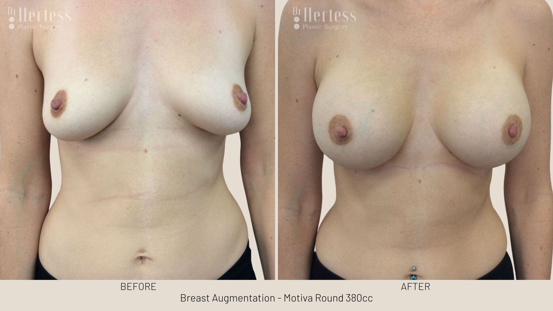 breast augmentation photos before and after