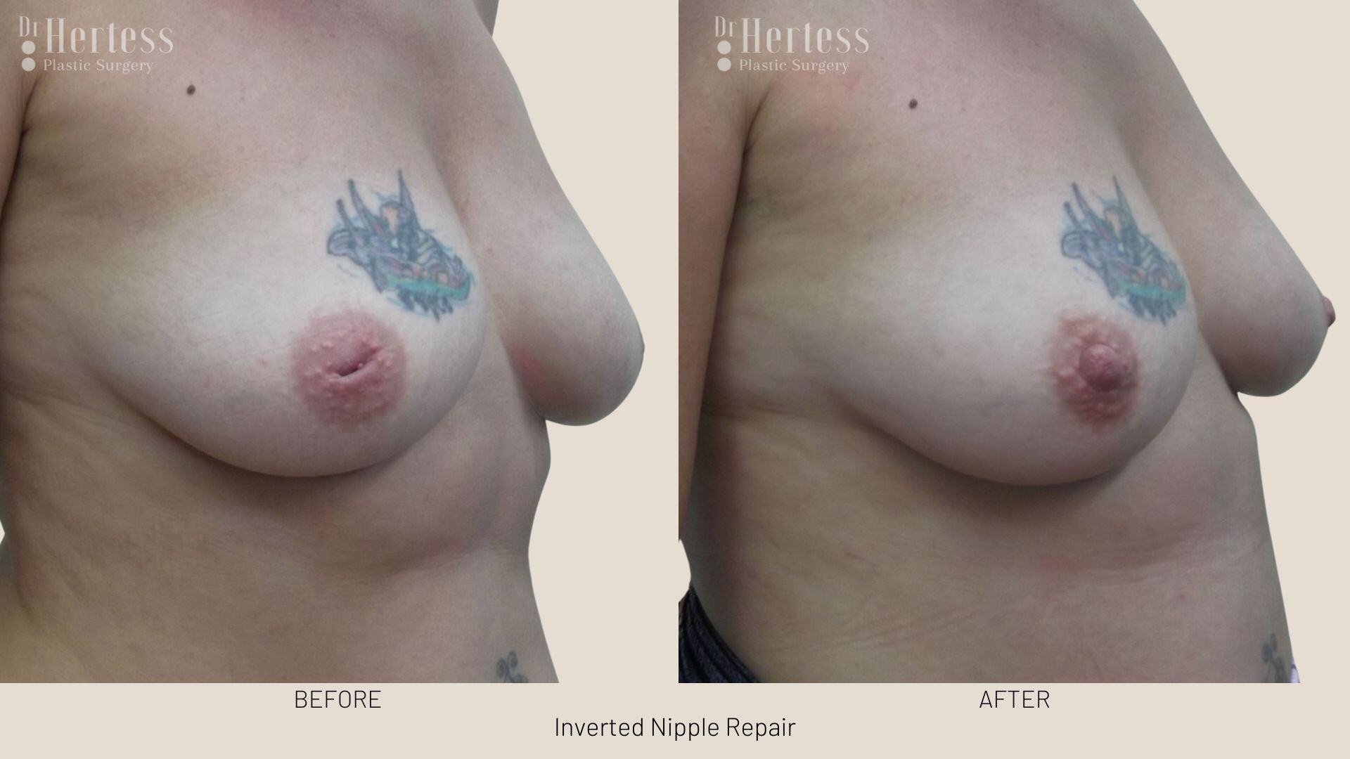 inverted nipple before after