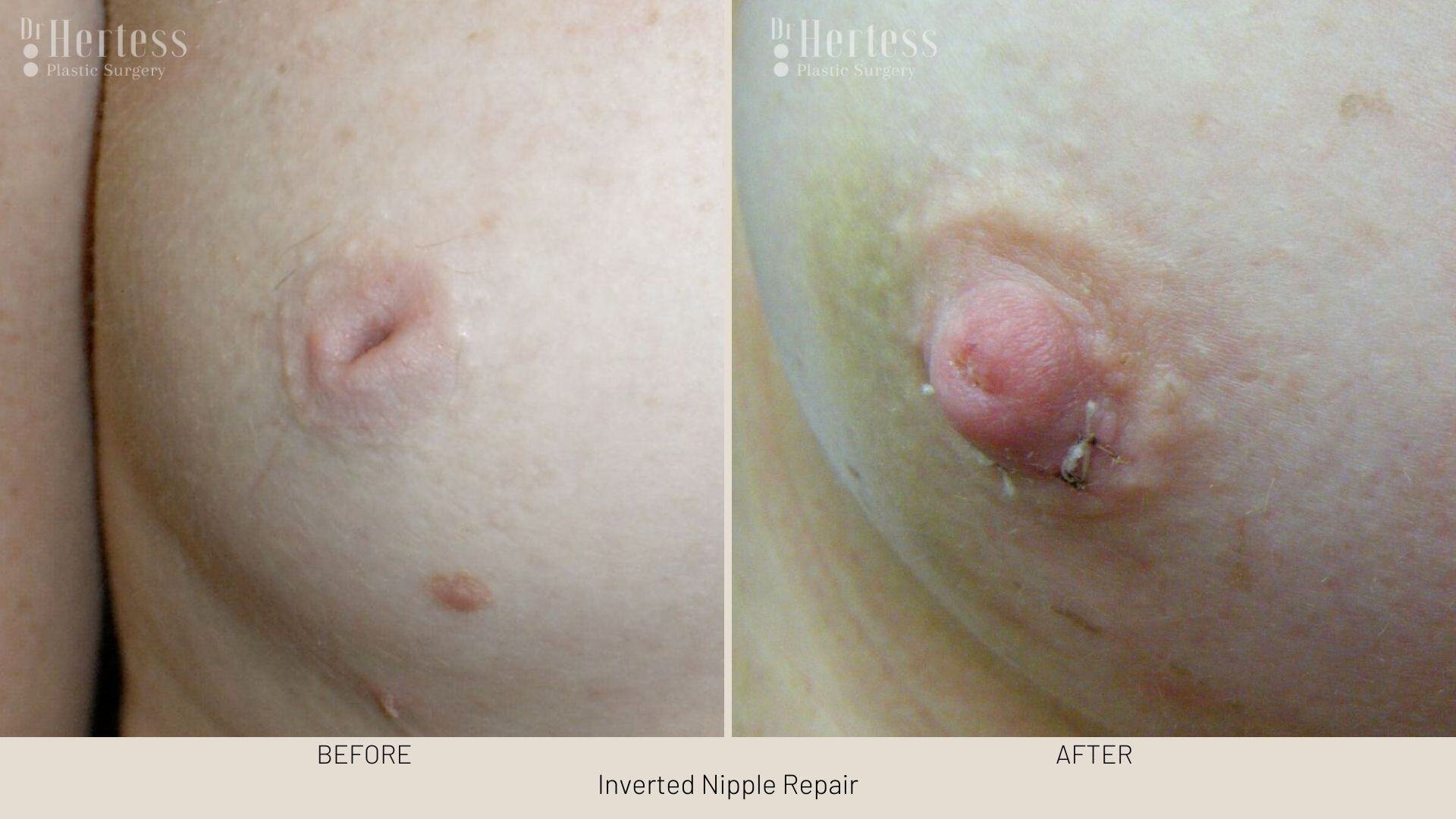 inverted nipple before after