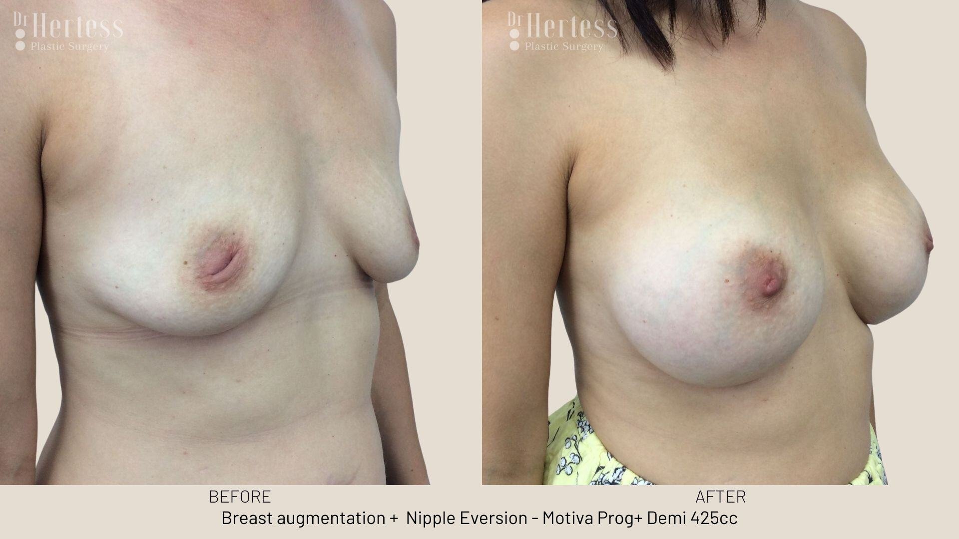 inverted nipple before after