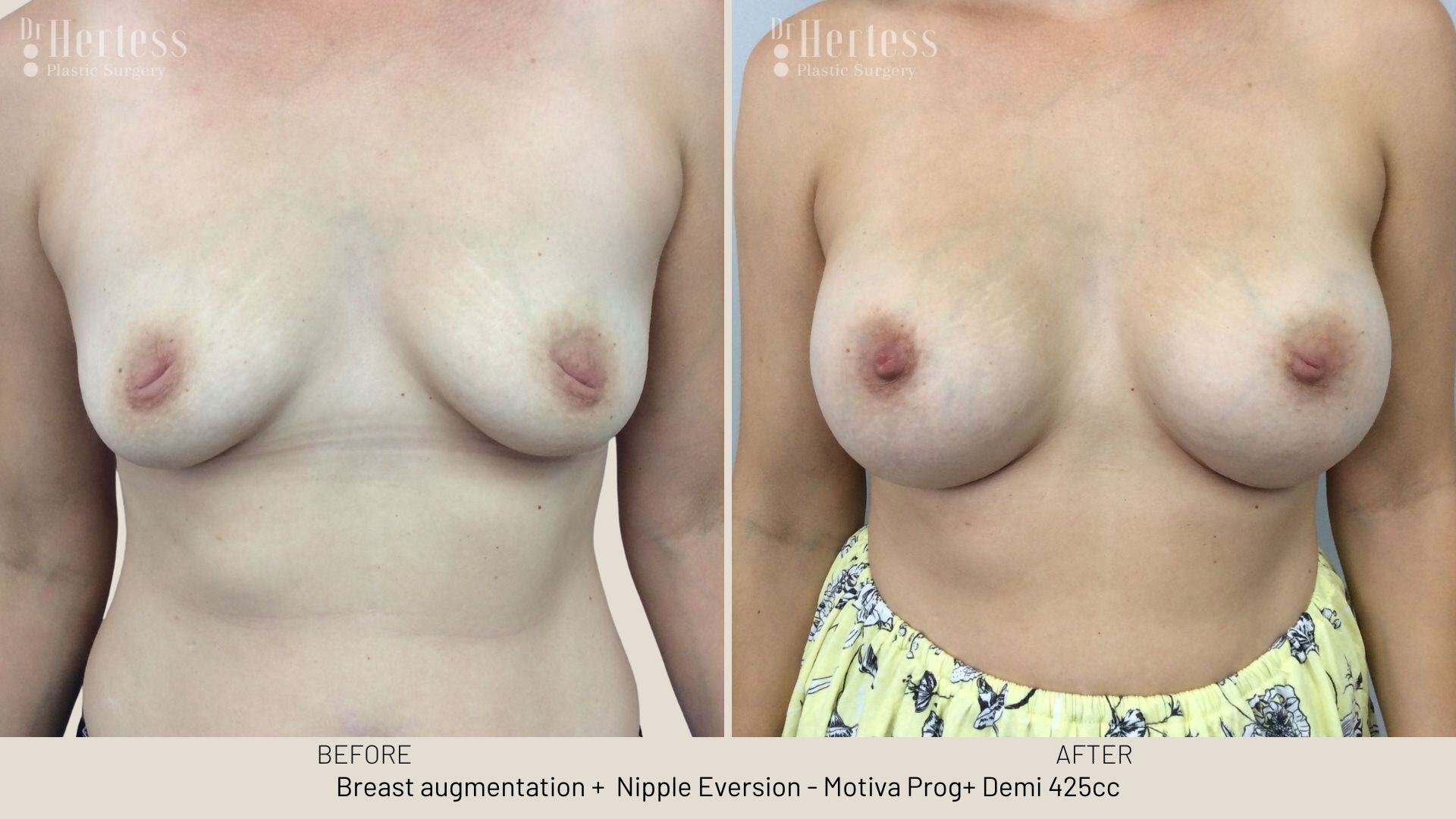 inverted nipple before after