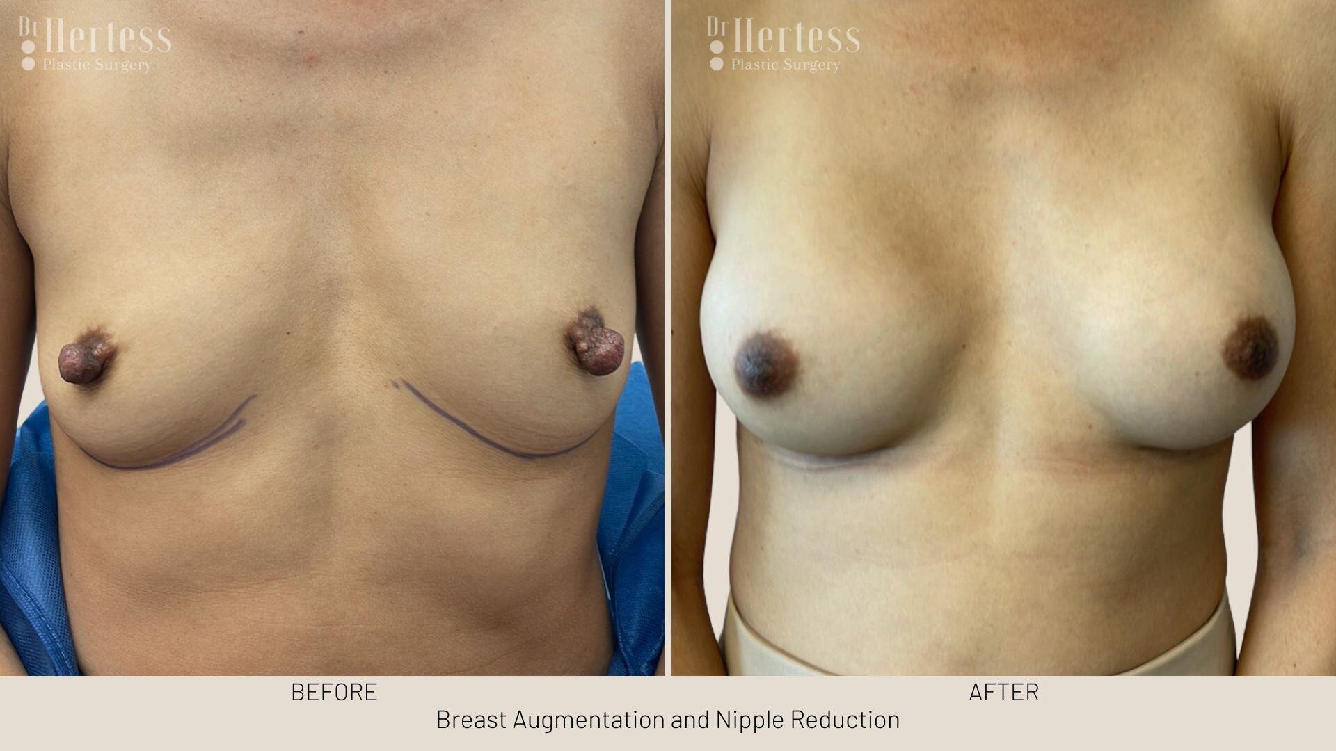 areolar reduction